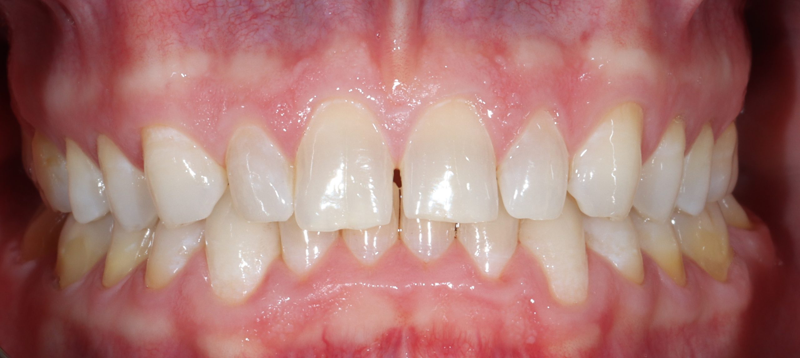 Kyle C before dental veneers