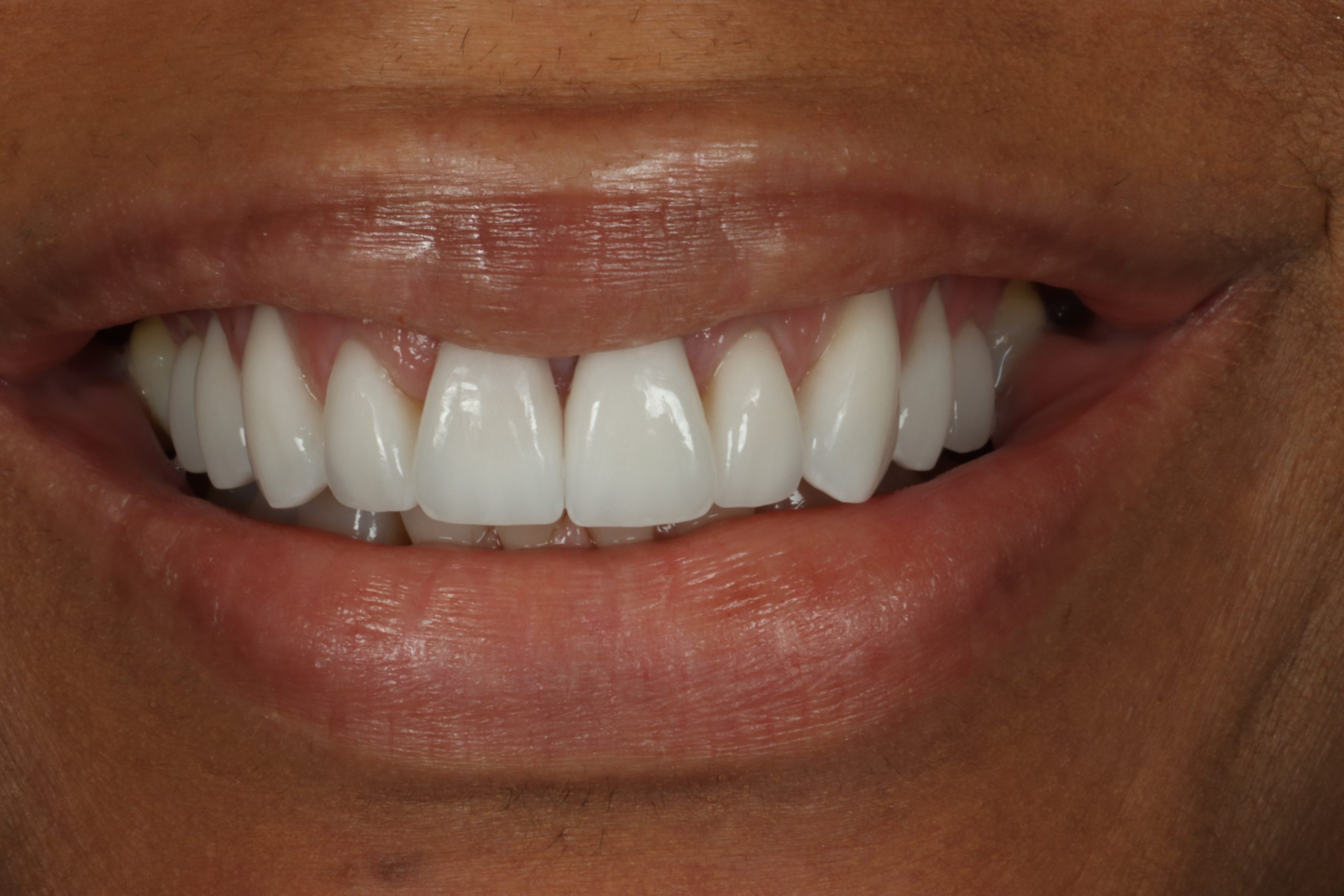 Lalita B after dental veneers