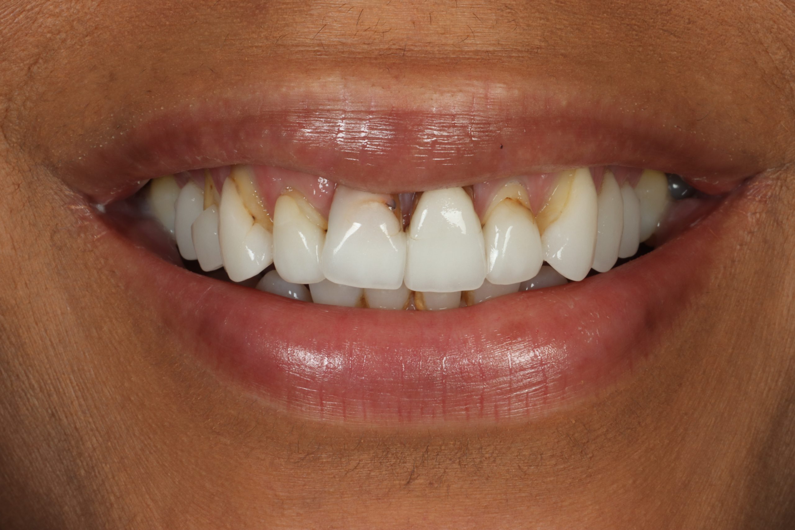 Lalita B before dental veneers