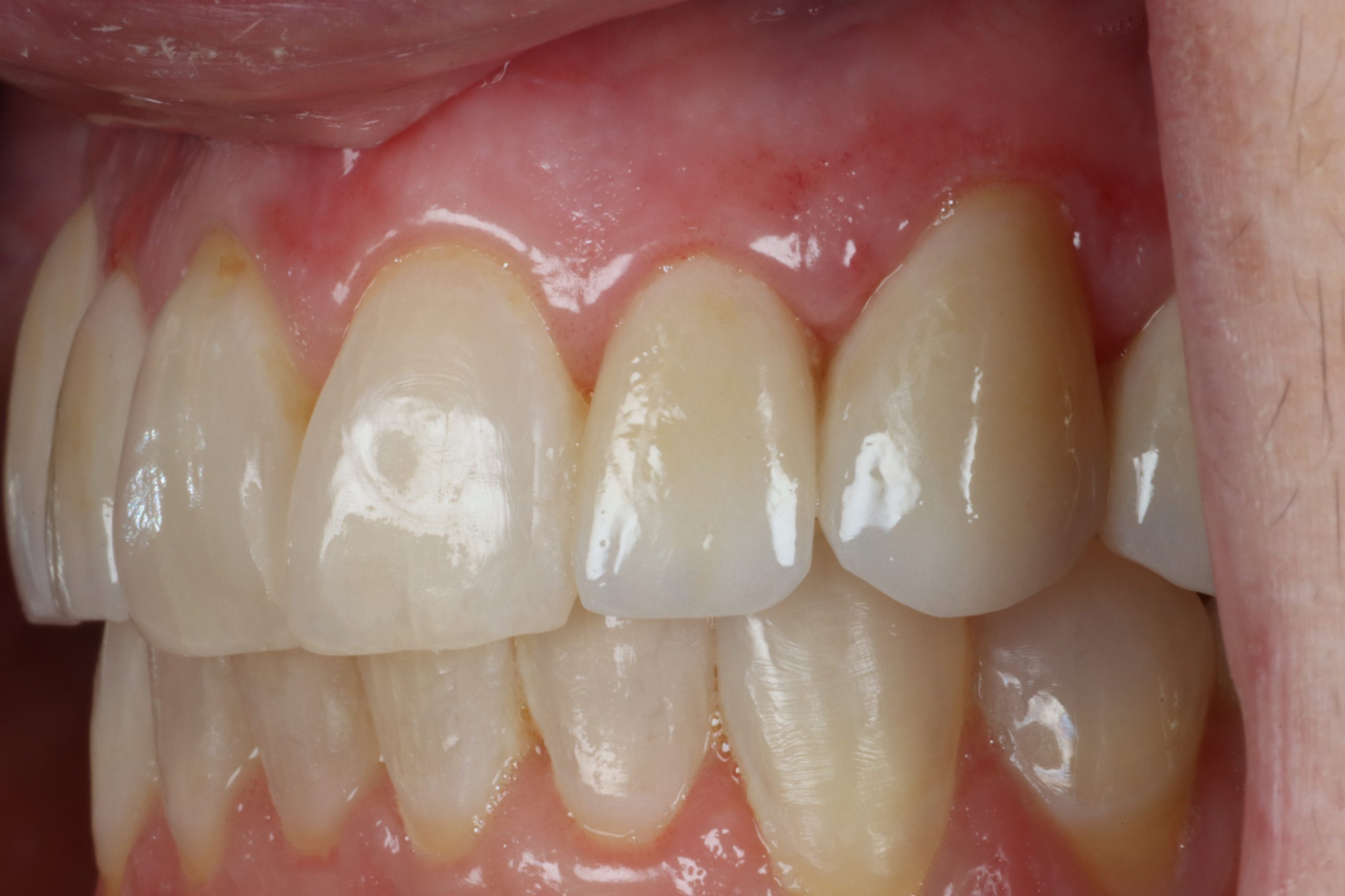 Laryssa K left view after dental veneers