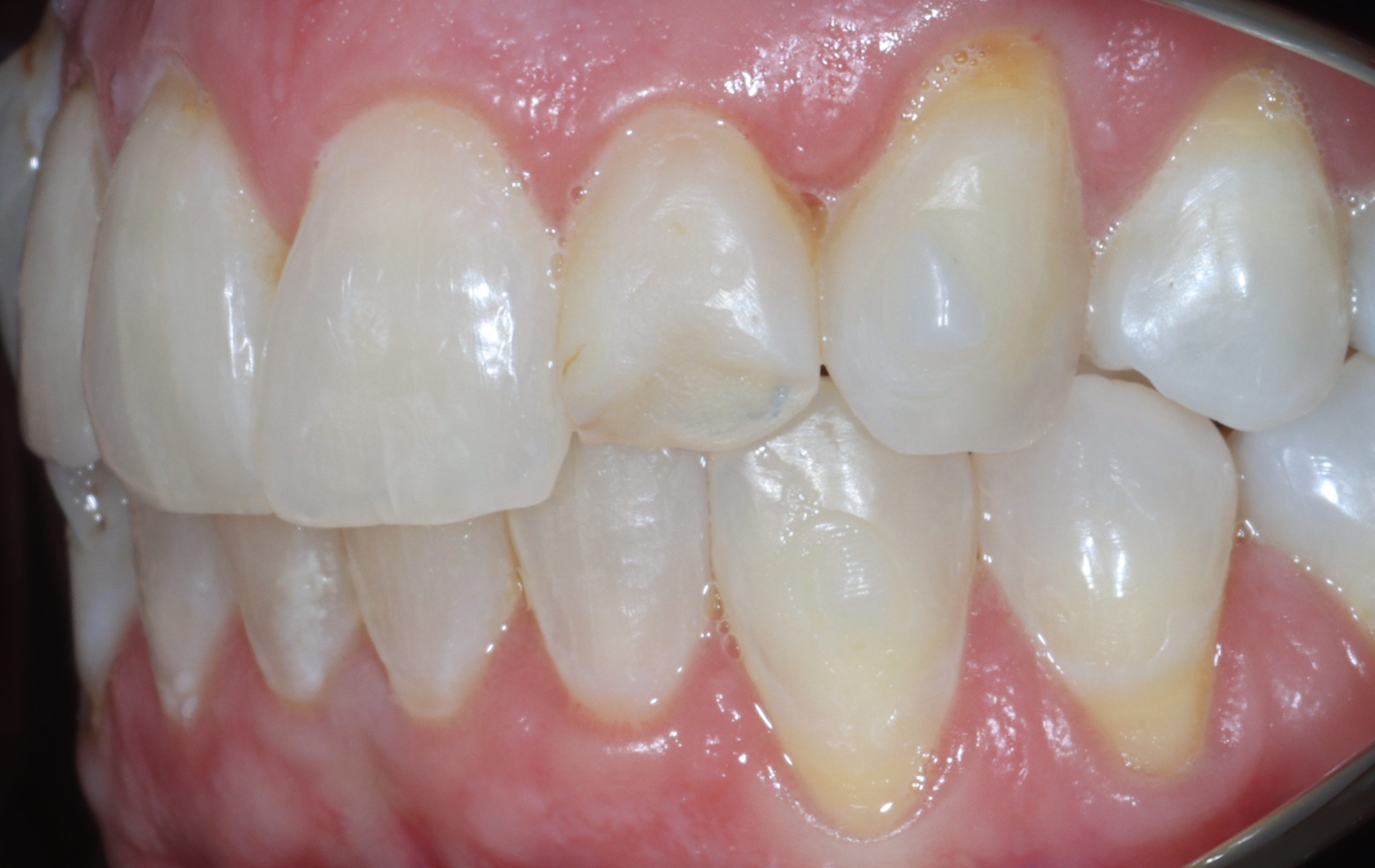 Laryssa K left view before dental veneers