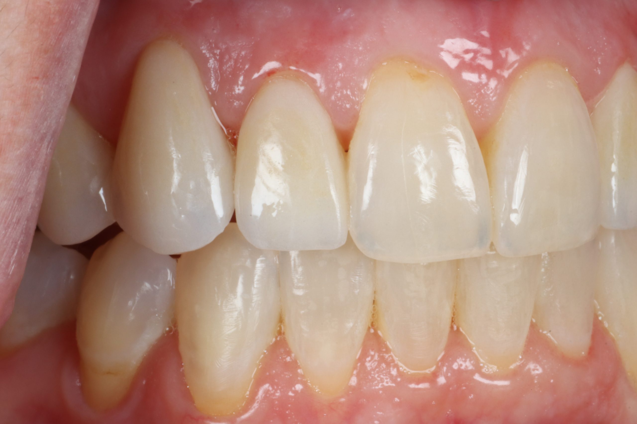 Laryssa K right view after dental veneers