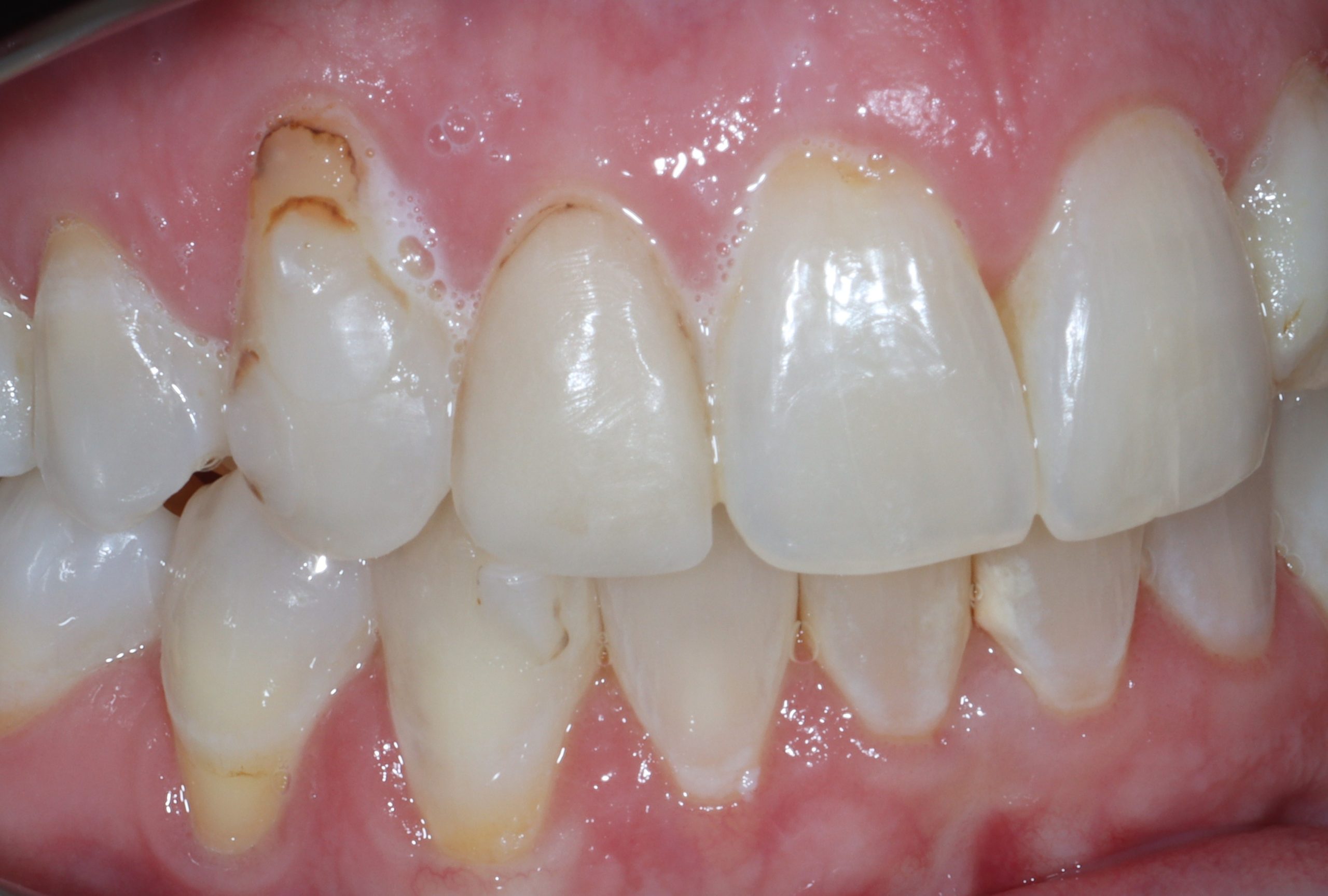 Laryssa K right view before dental veneers