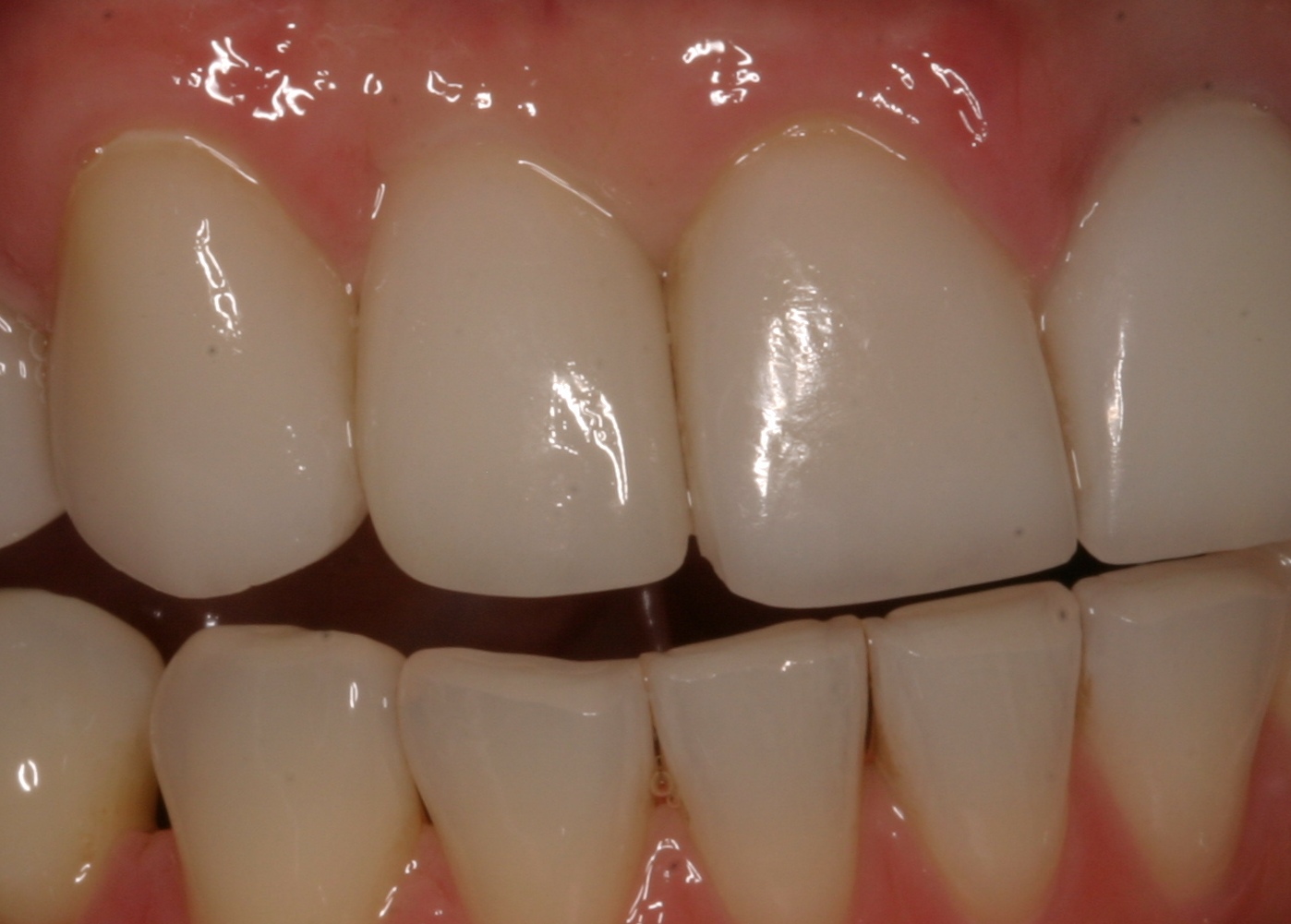 Lateral implant after restored implants