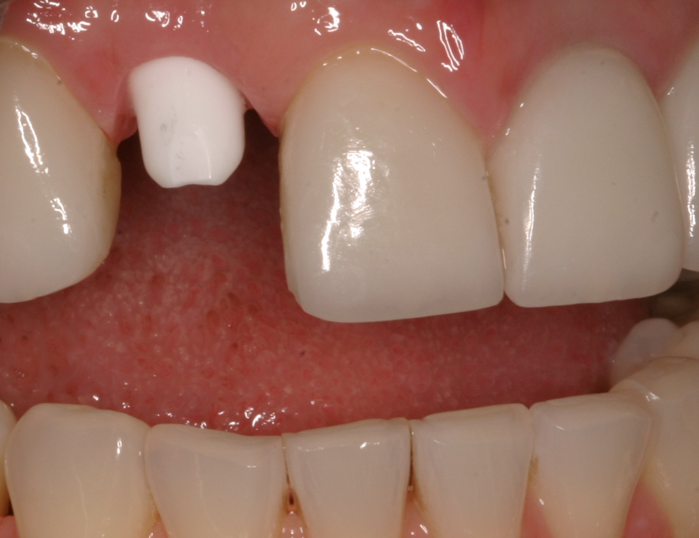 Lateral implant before restored implants