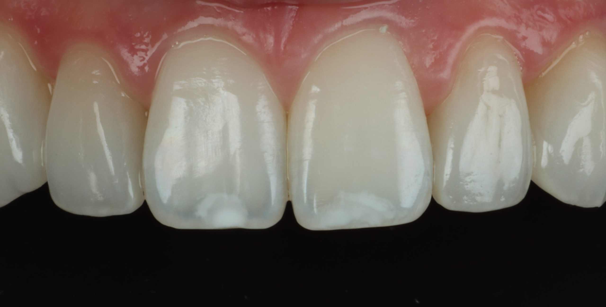 After lateral veneers