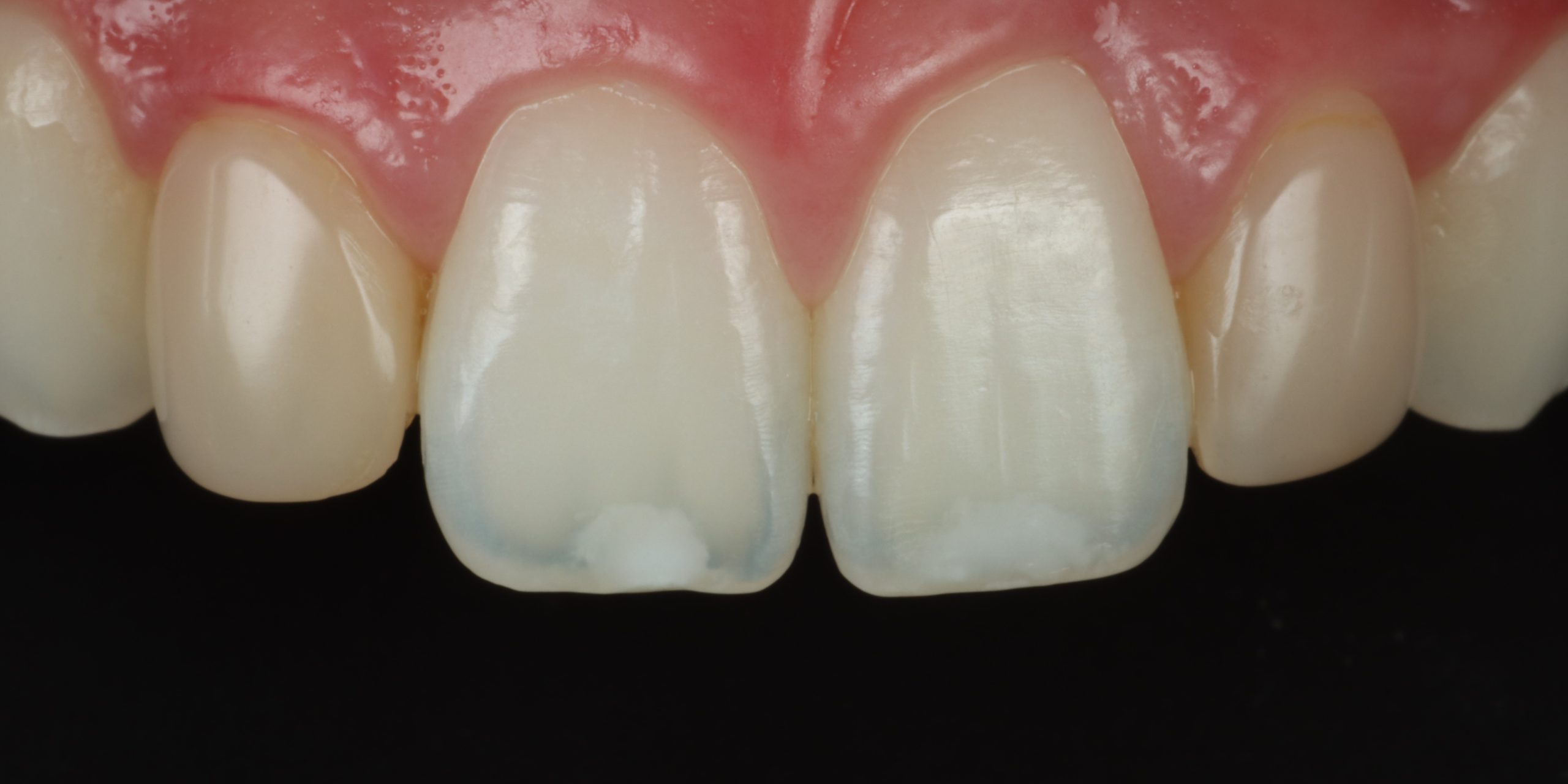 Before lateral veneers
