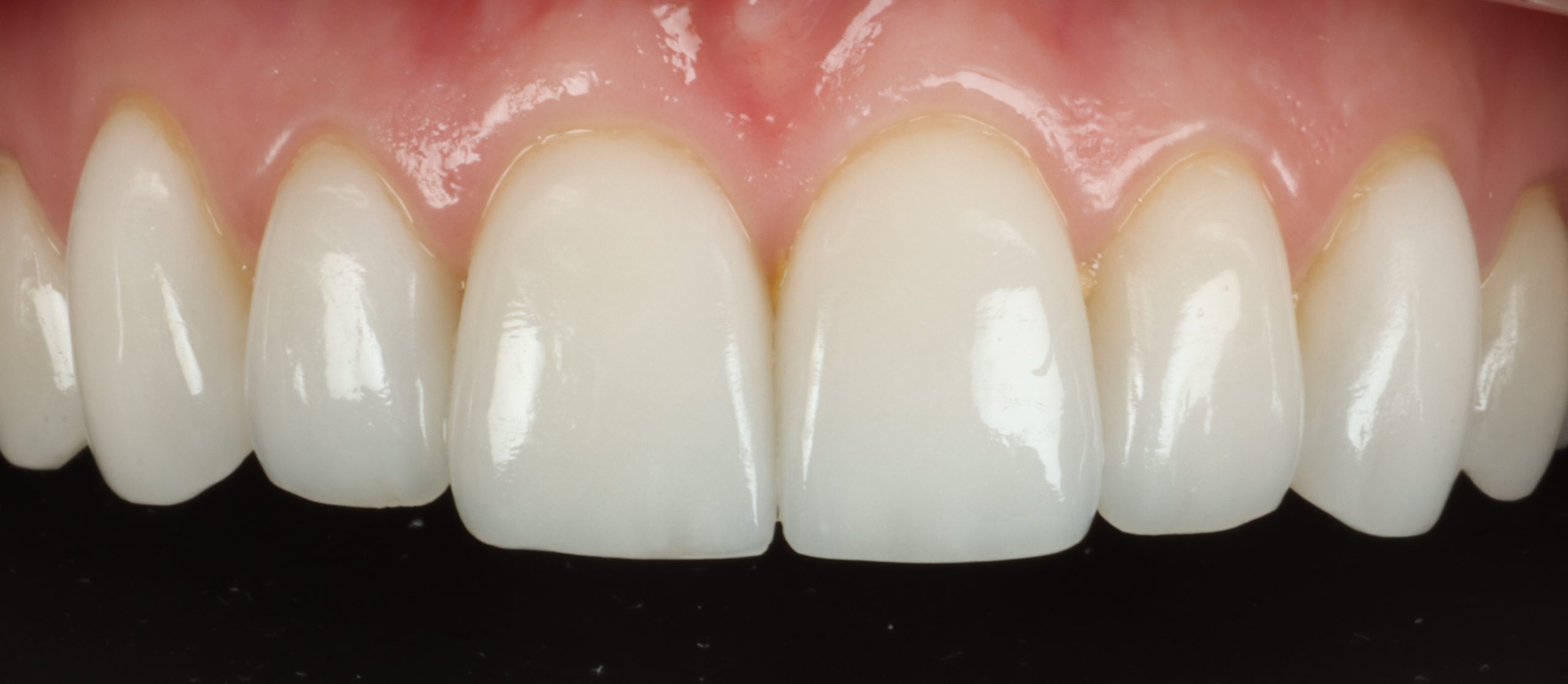 Lindsey H after dental veneers