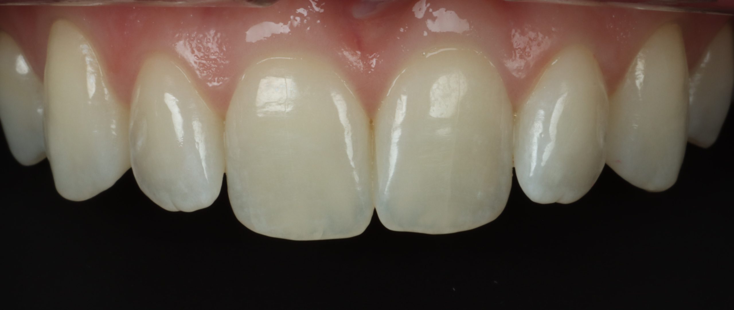 Lindsey H before dental veneers