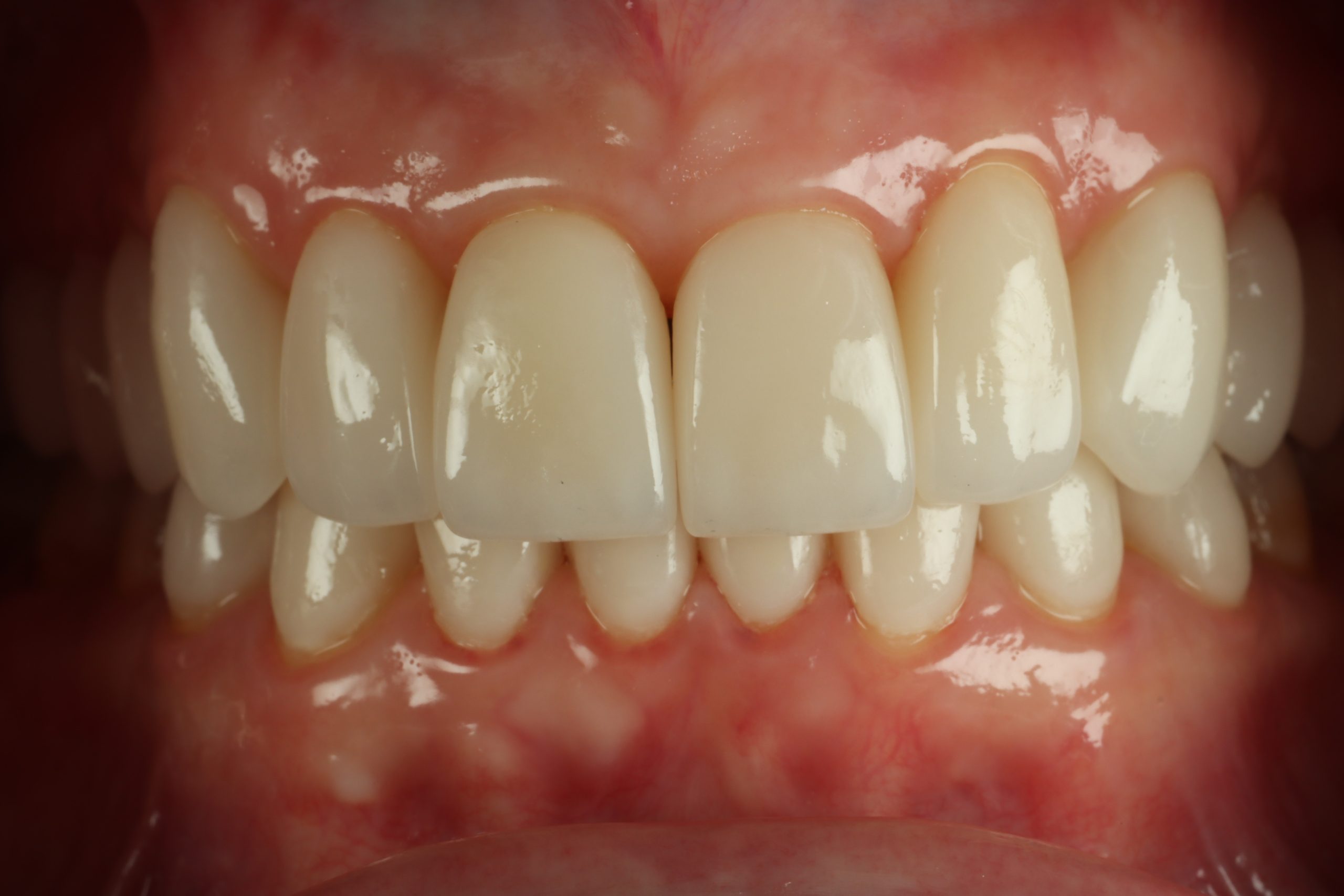 Lori B close-up after smile rejuvenation