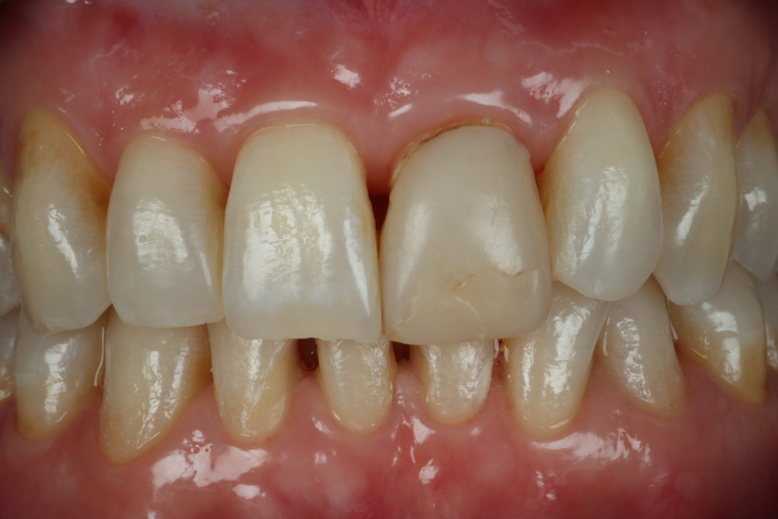 Lori B close-up before smile rejuvenation