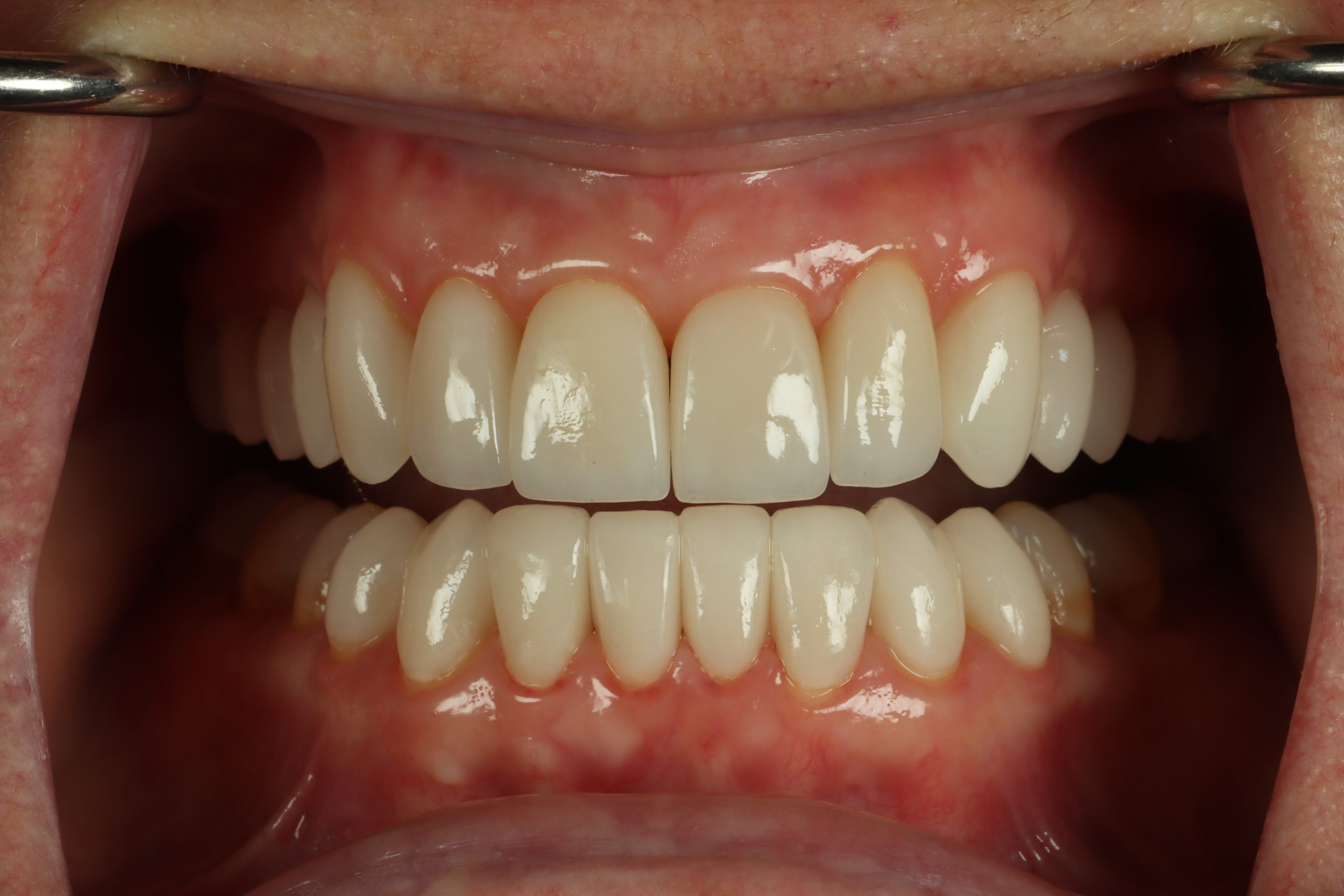 Lori B retracted after smile rejuvenation