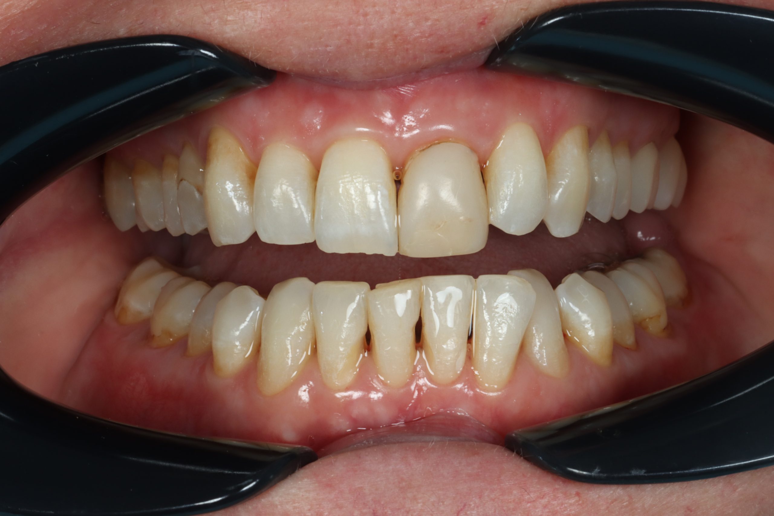 Lori B retracted before smile rejuvenation