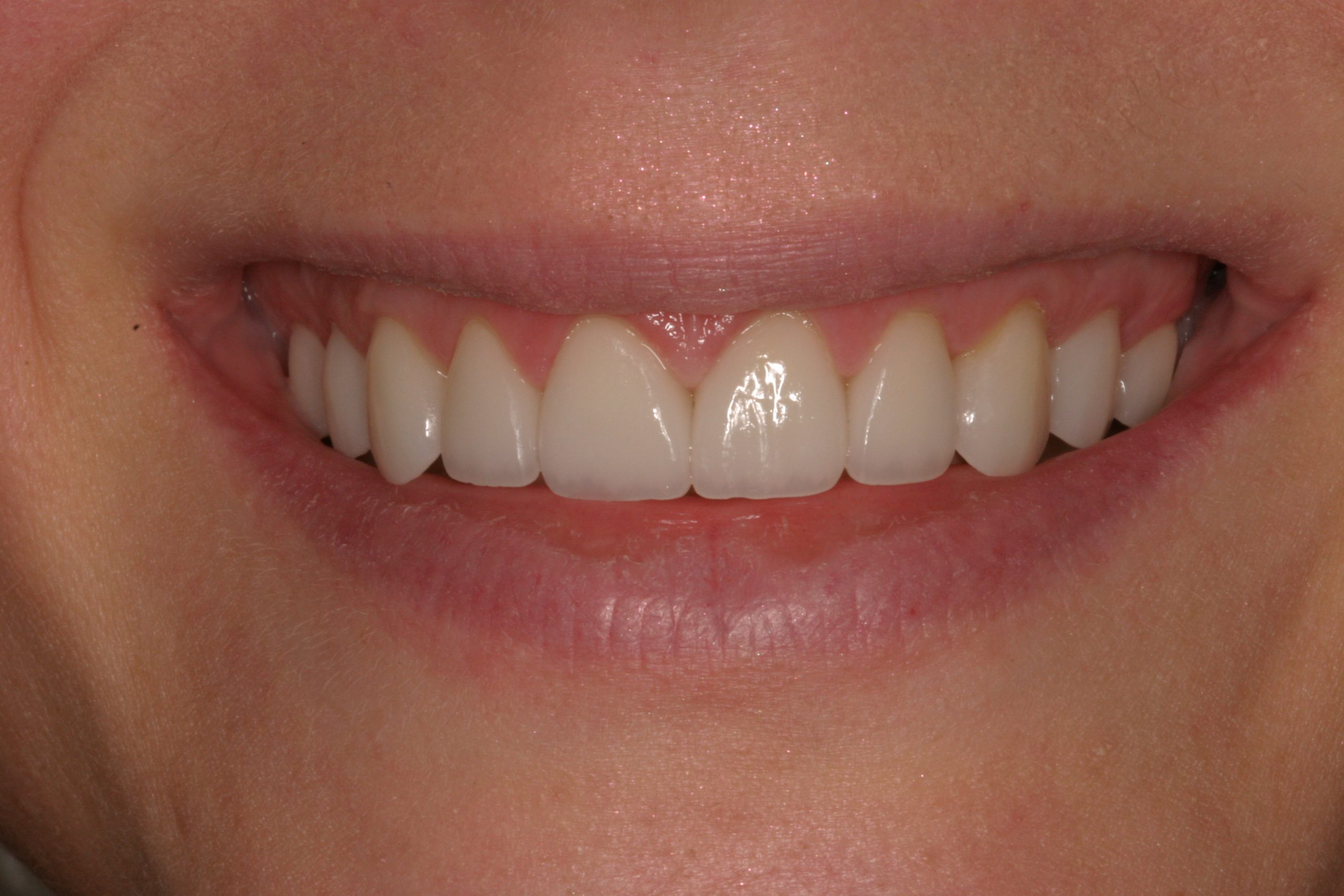 Lya M after smile rejuvenation