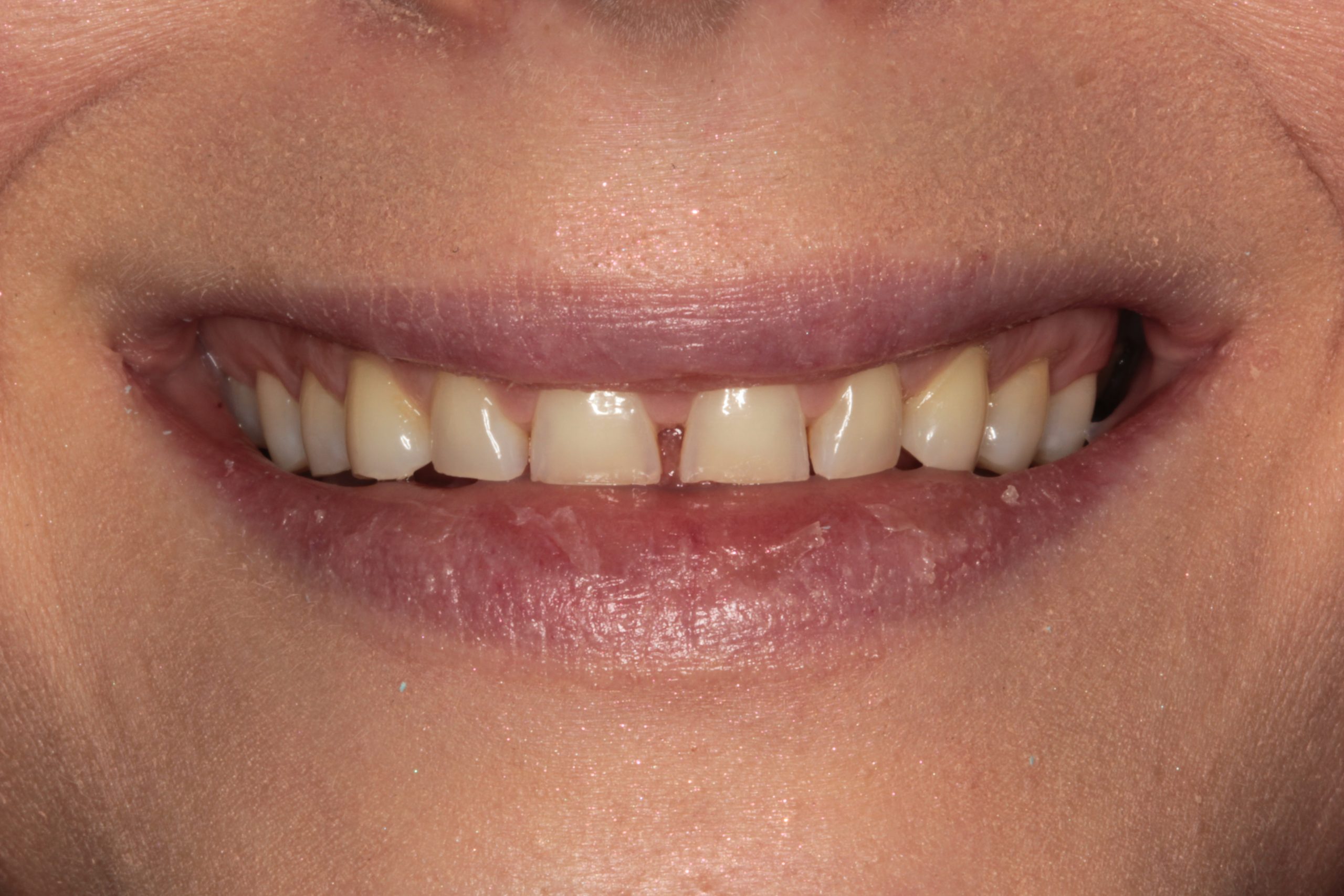 Lya M before smile rejuvenation