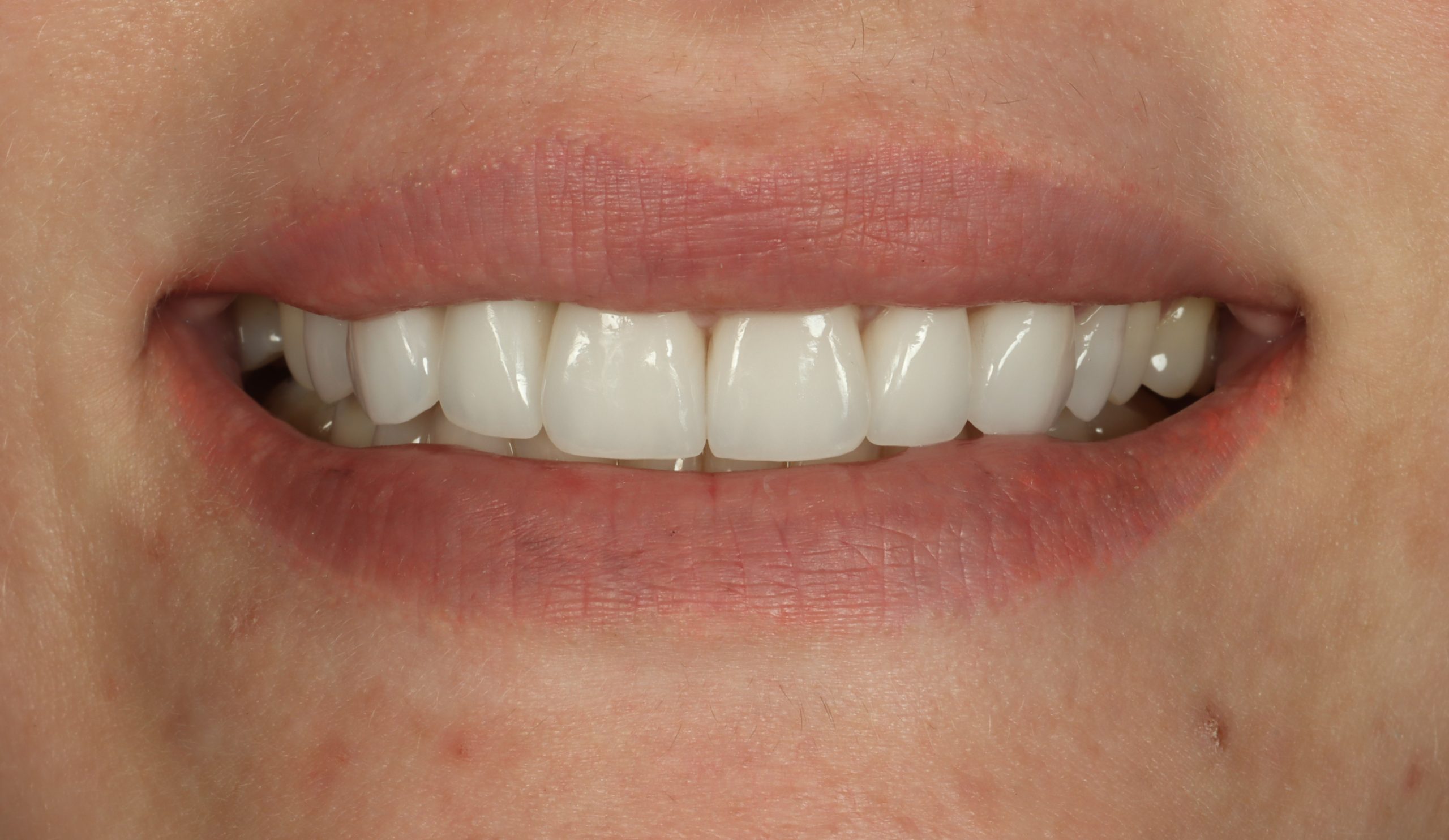 Mariami K after smile rejuvenation