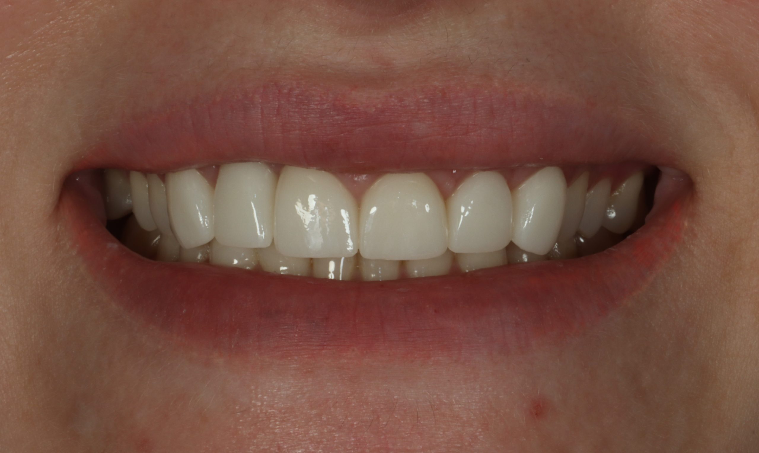 Mariami K before smile rejuvenation
