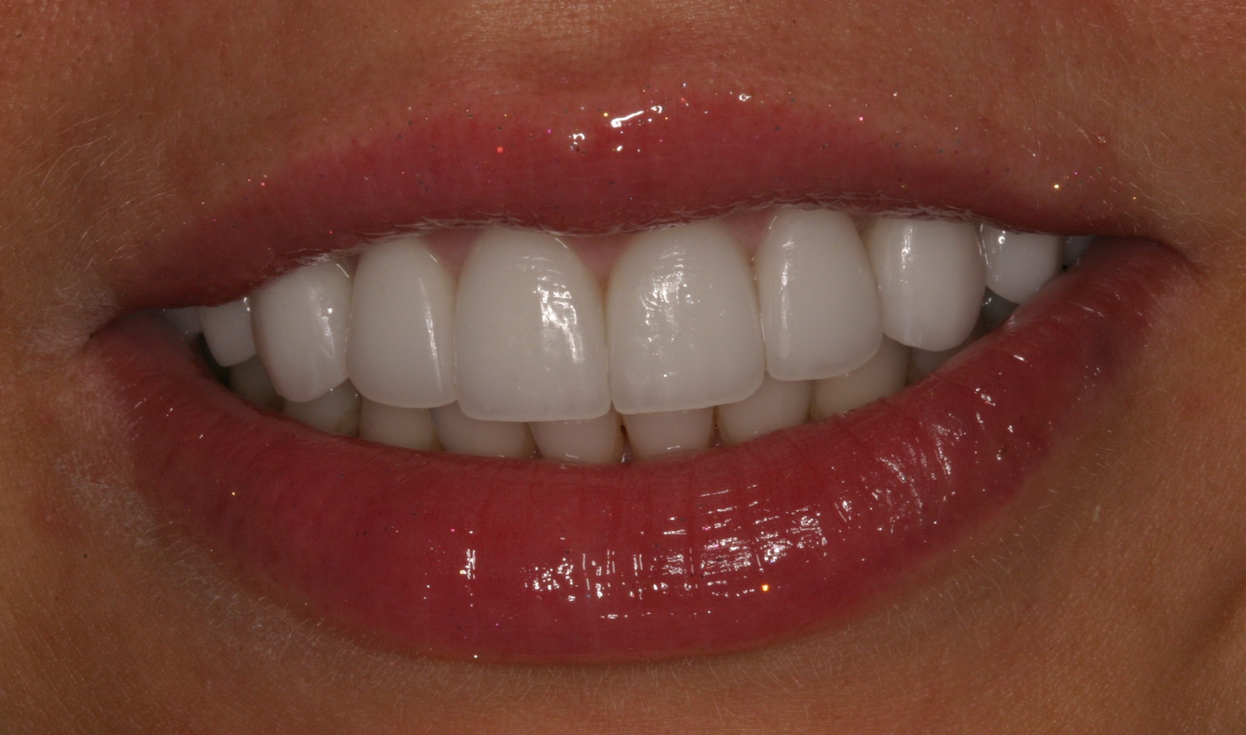 Marisa P after gummy smiles