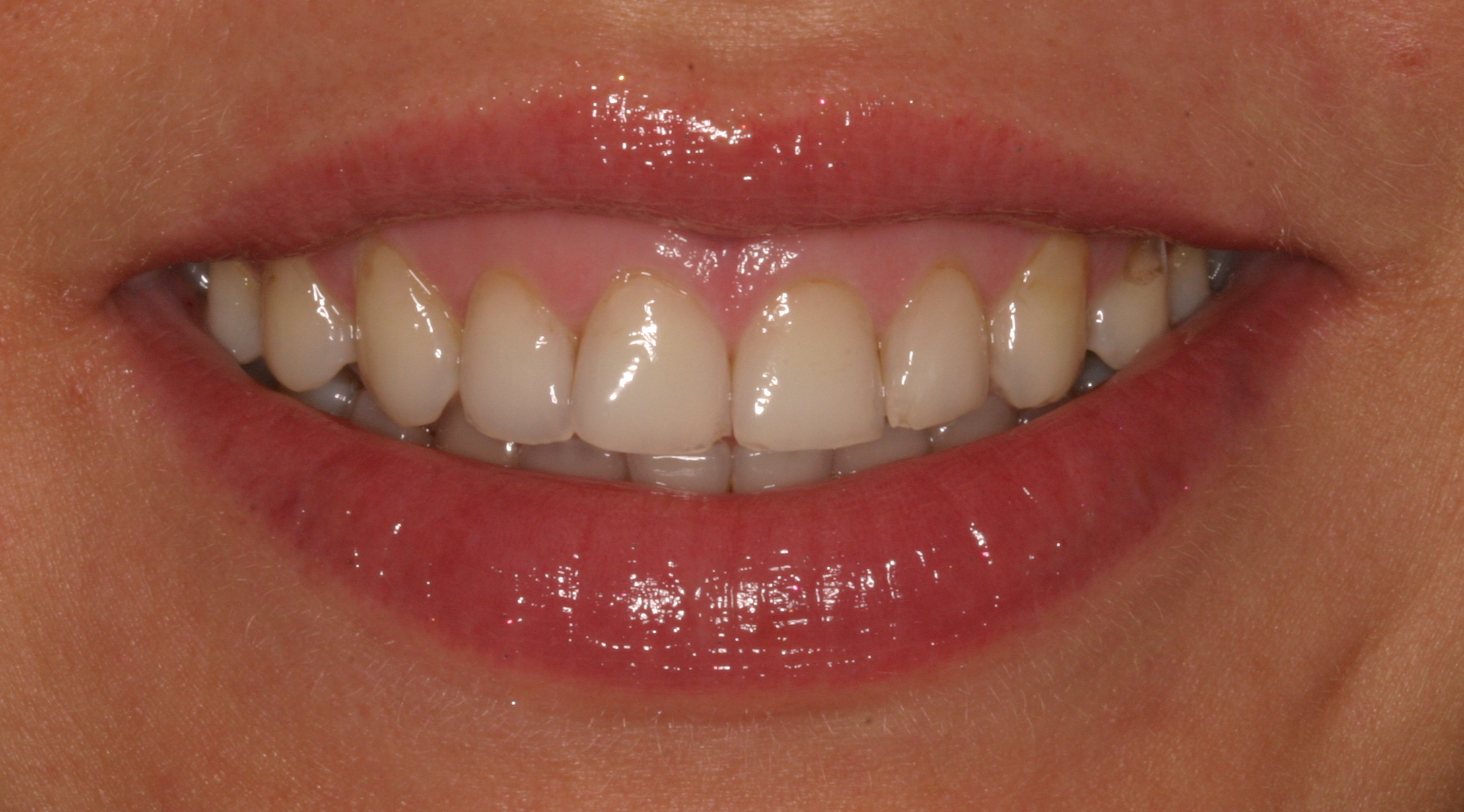 Marisa P before gummy smiles