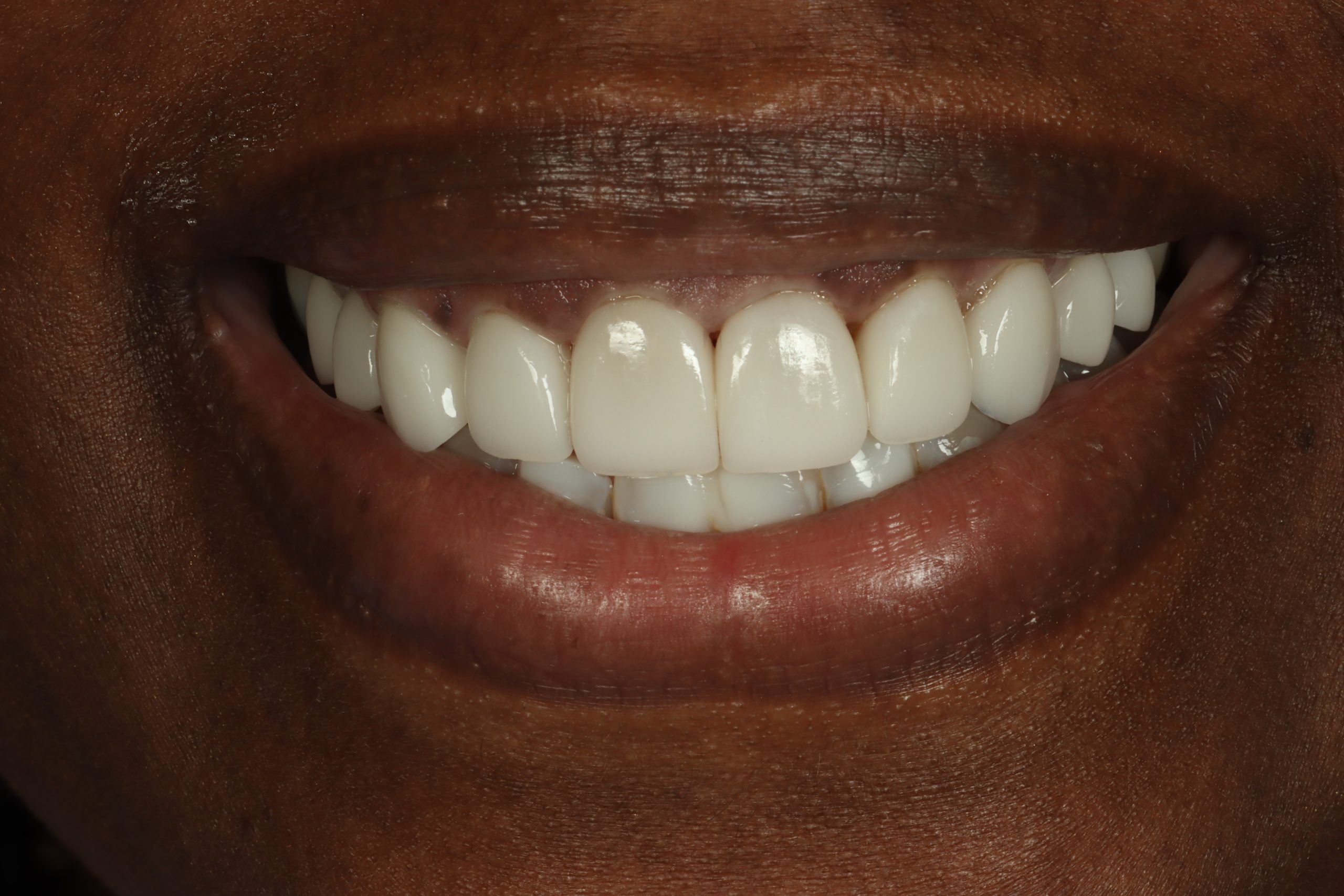 Nicole T after discolored teeth