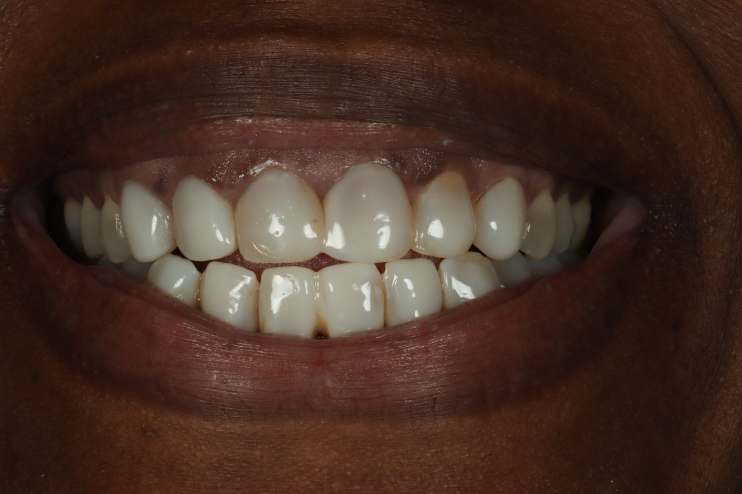 Nicole T before discolored teeth