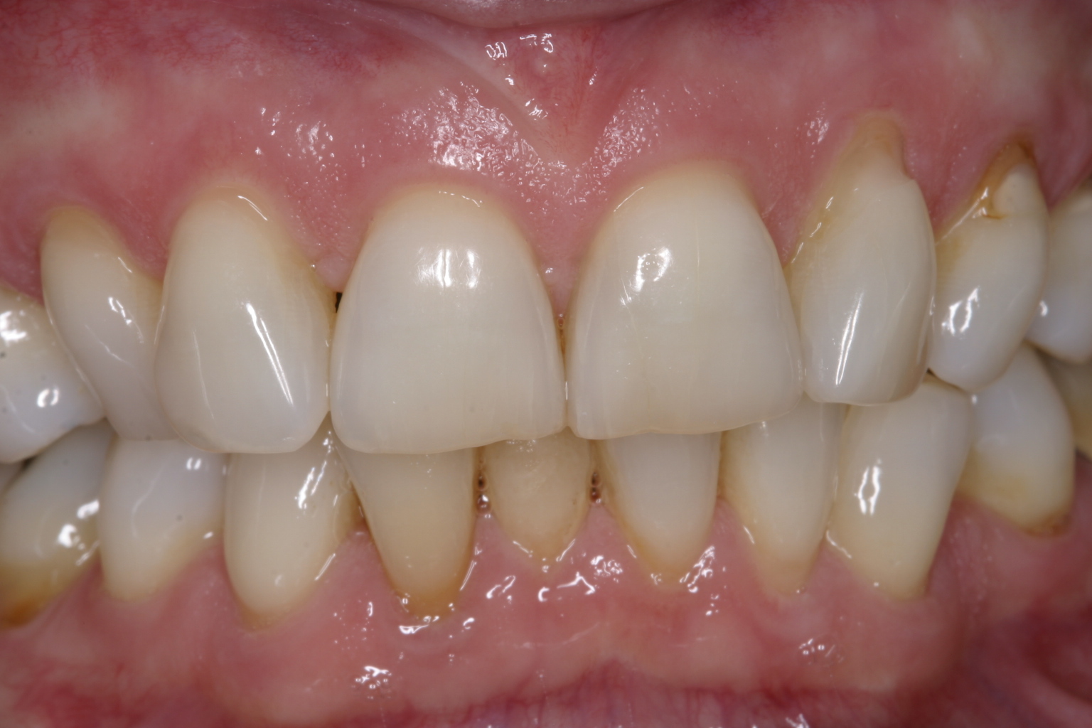 Nina F before dental veneers