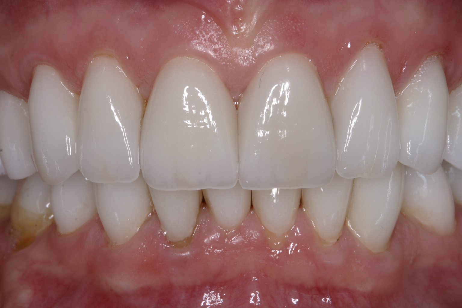 Nina F after dental veneers