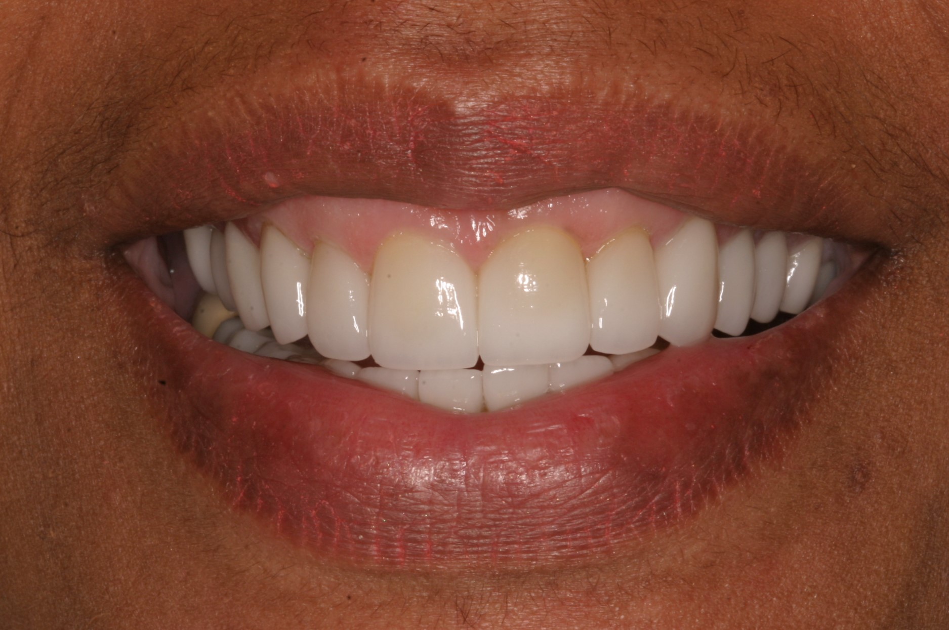 Pat Murray after gummy smiles