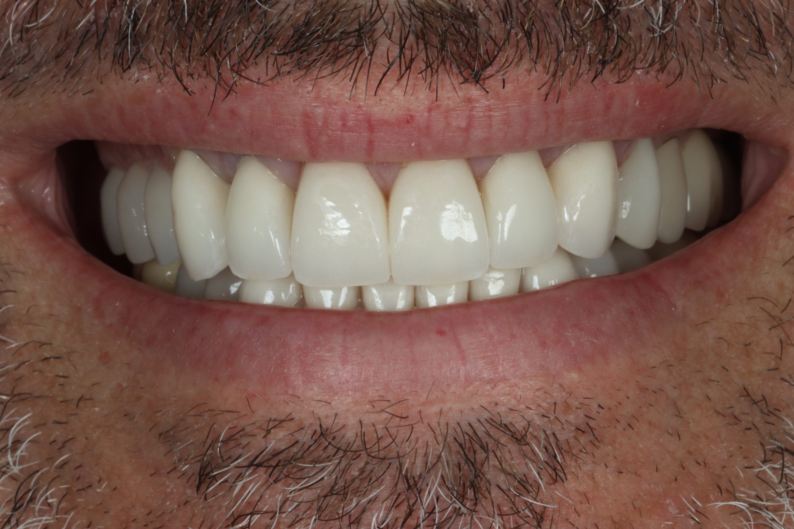 Philip S after smile rejuvenation