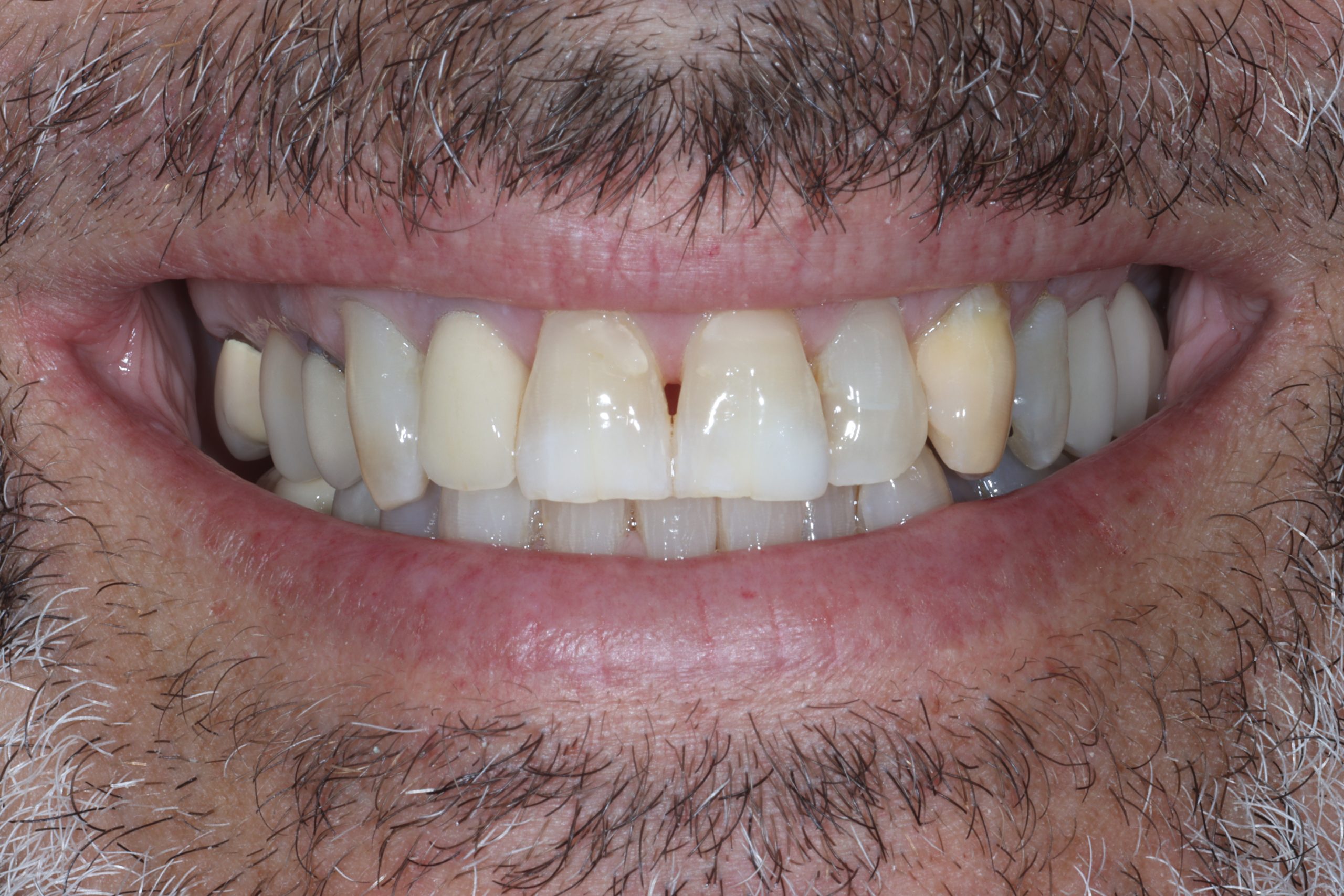 Philip S before smile rejuvenation