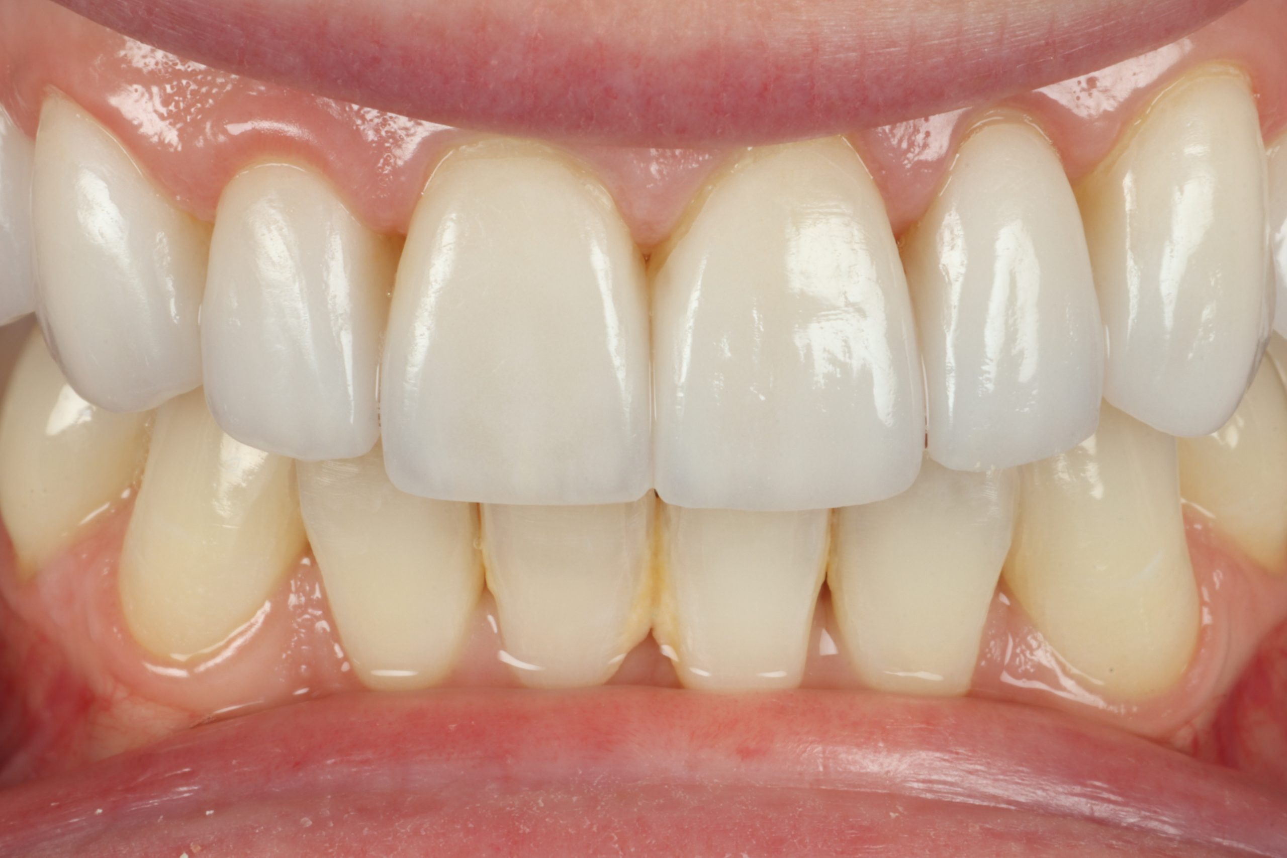 R Putman after dental veneers
