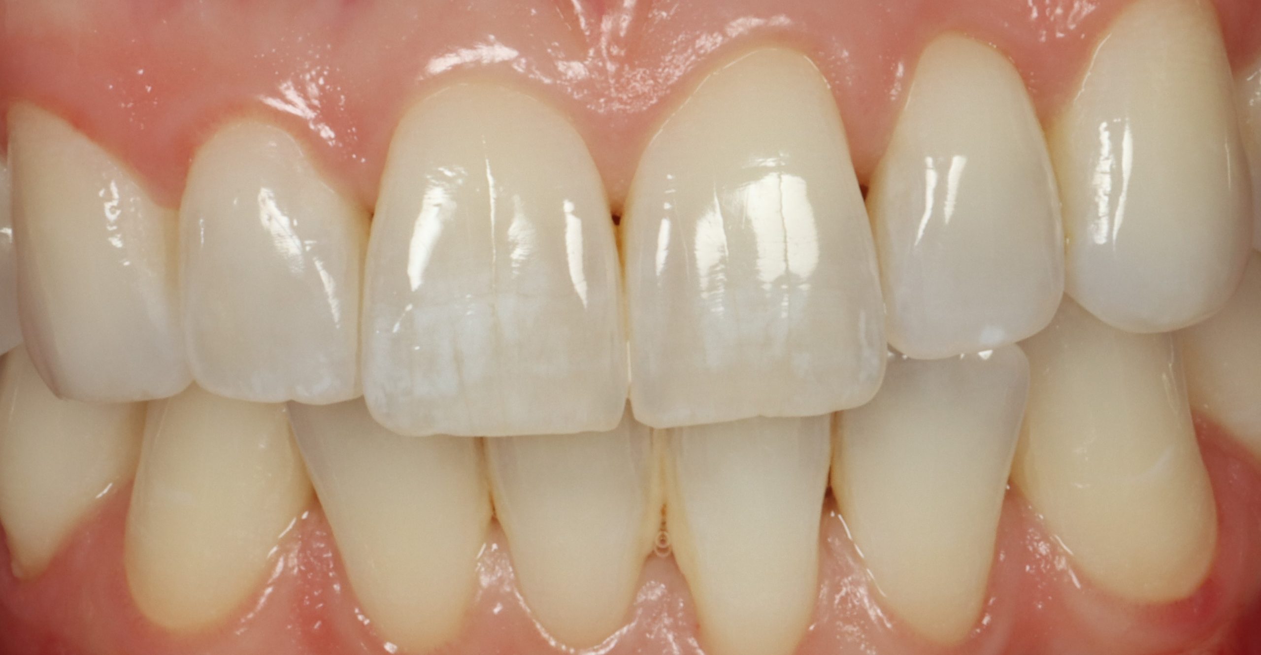 R Putman before dental veneers