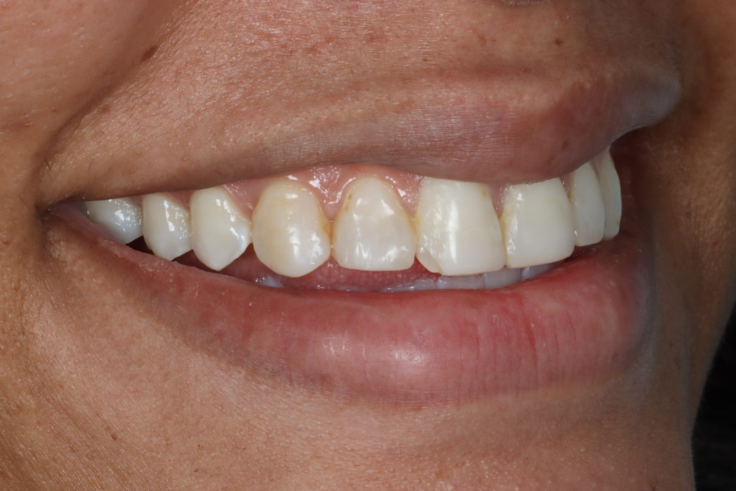 Ronalda before dental veneers
