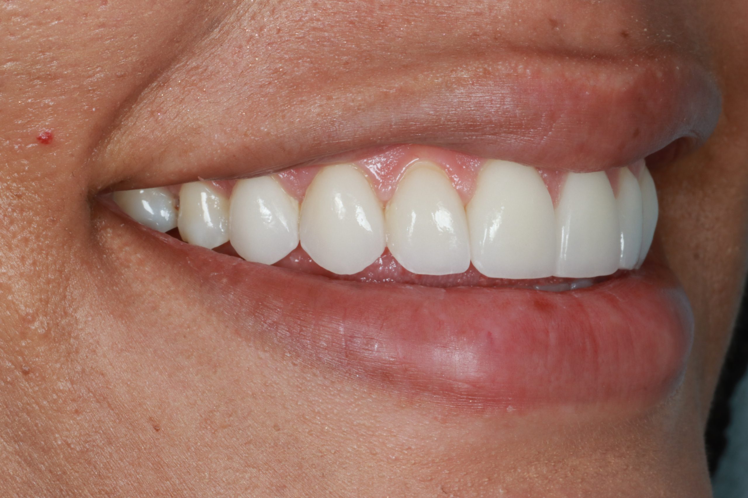 Ronalda after dental veneers