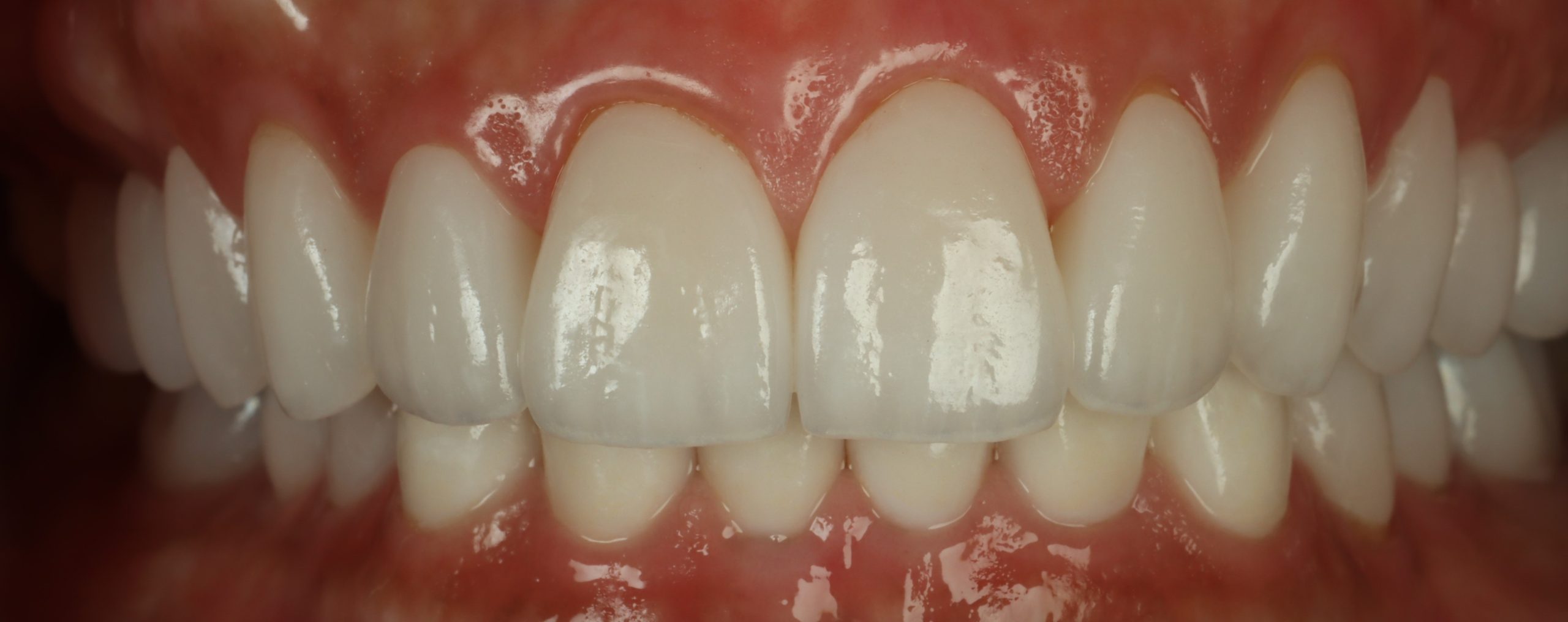 Shari H after smile rejuvenation