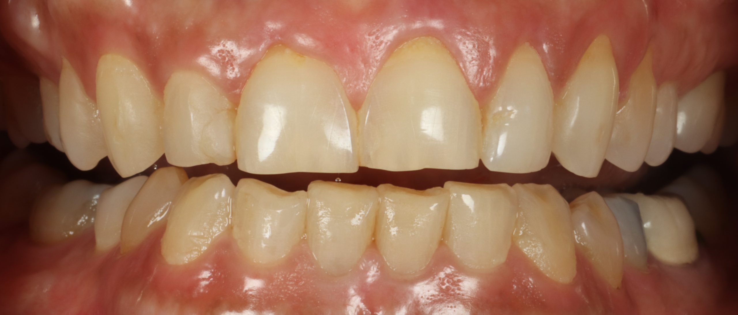 Shari H before smile rejuvenation
