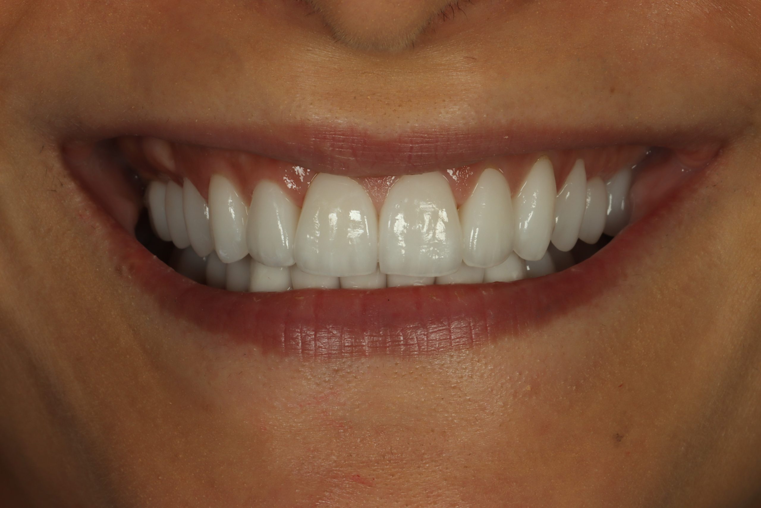 Sheri H after worn teeth