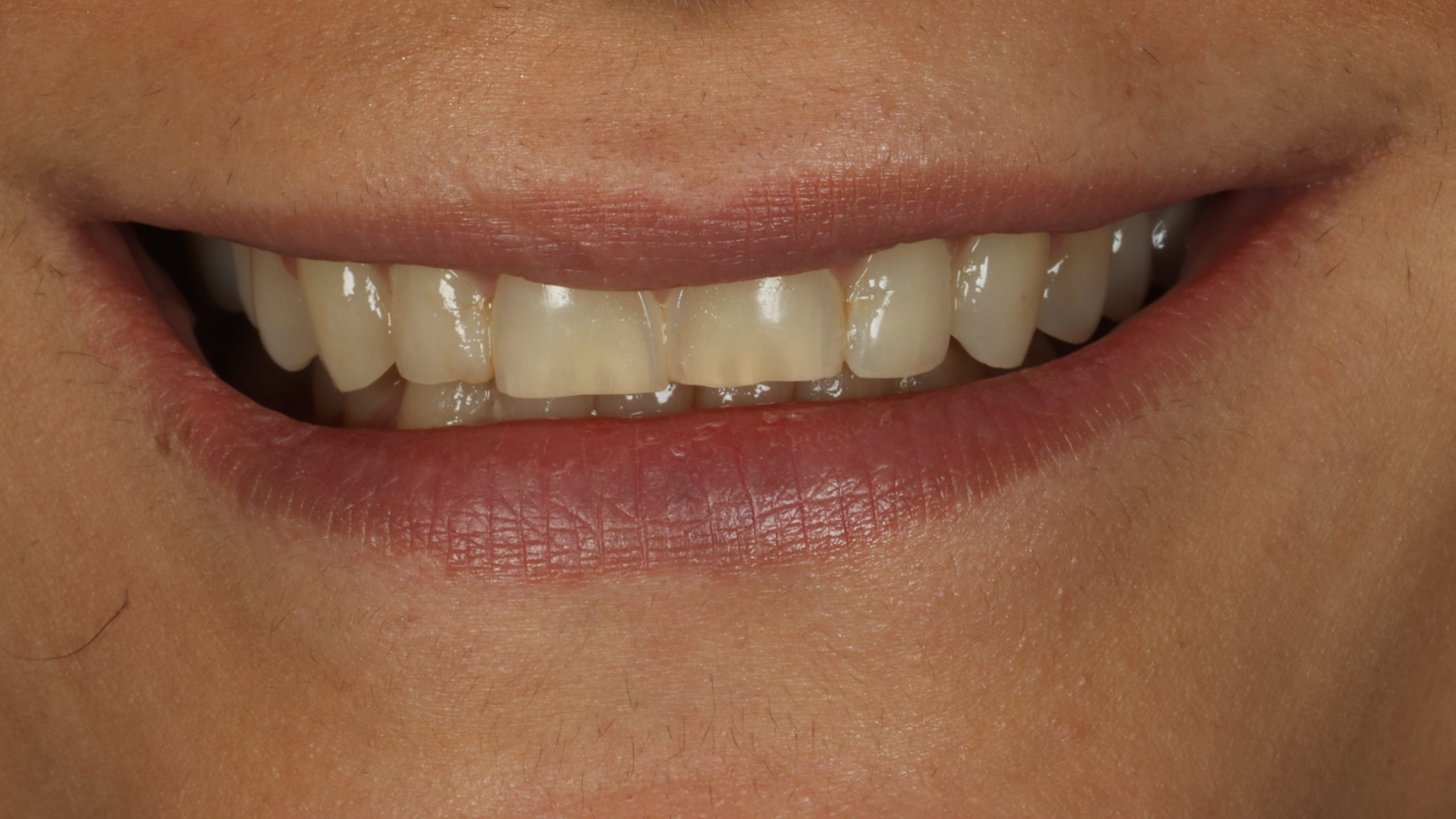 Sheri H before worn teeth
