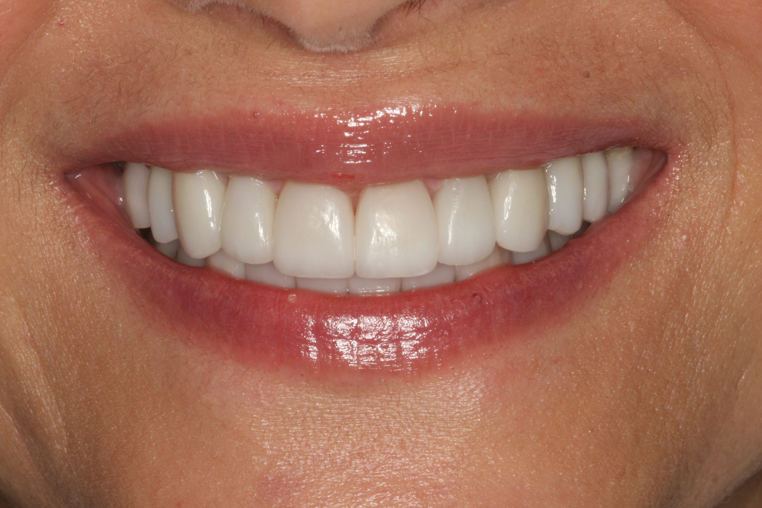 Shiva after worn teeth