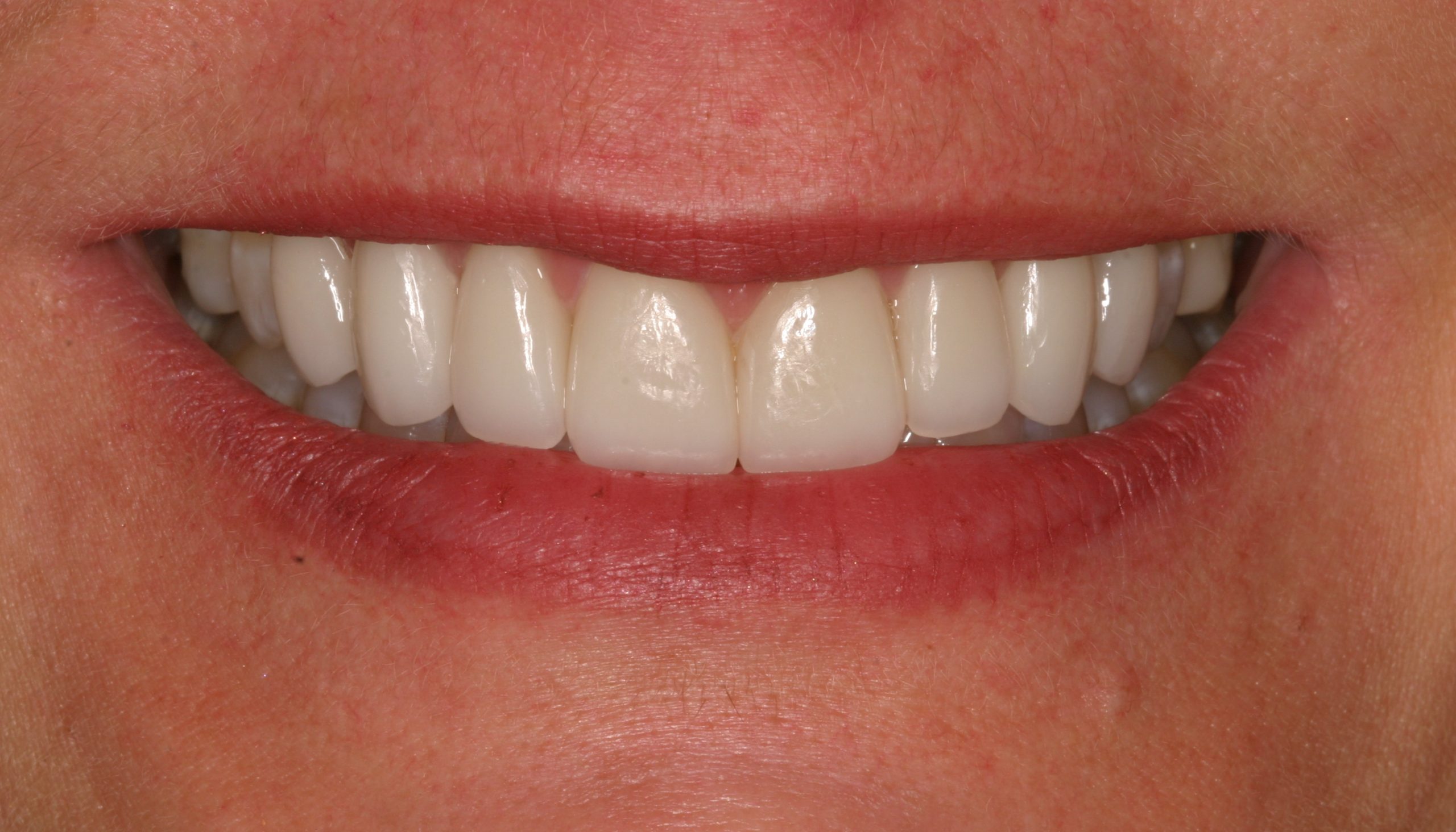 Susan C.W. after discolored teeth