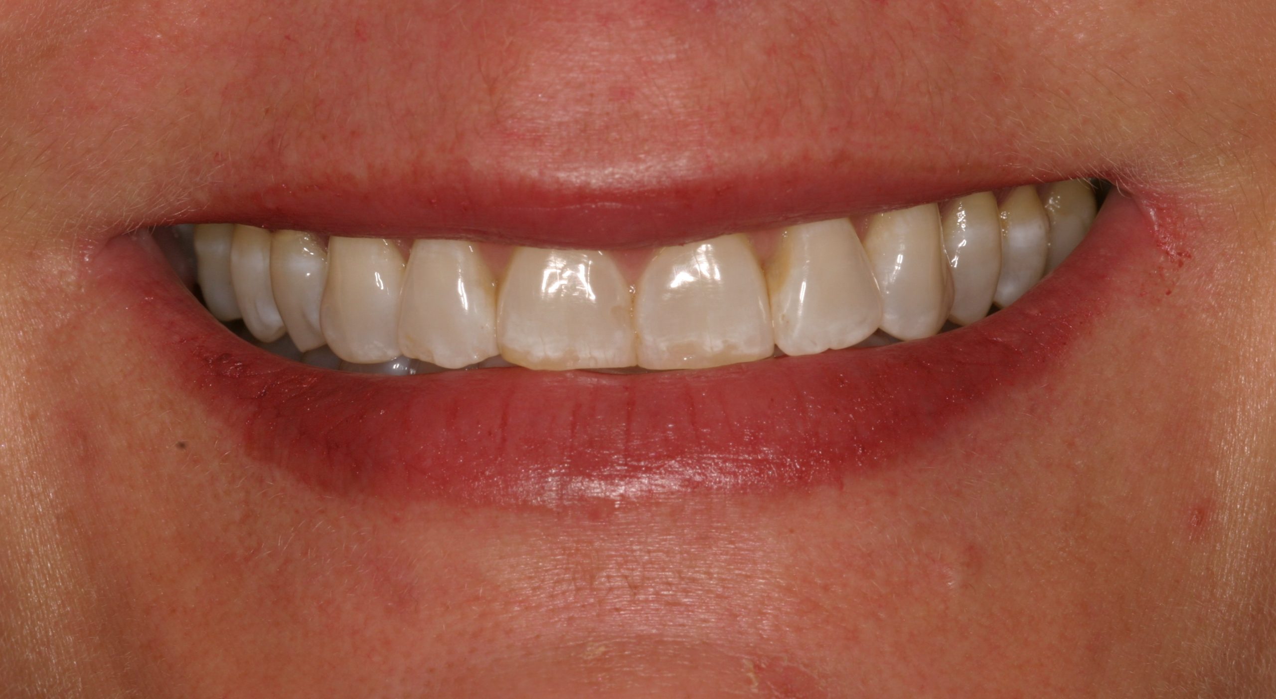 Susan C.W. before discolored teeth
