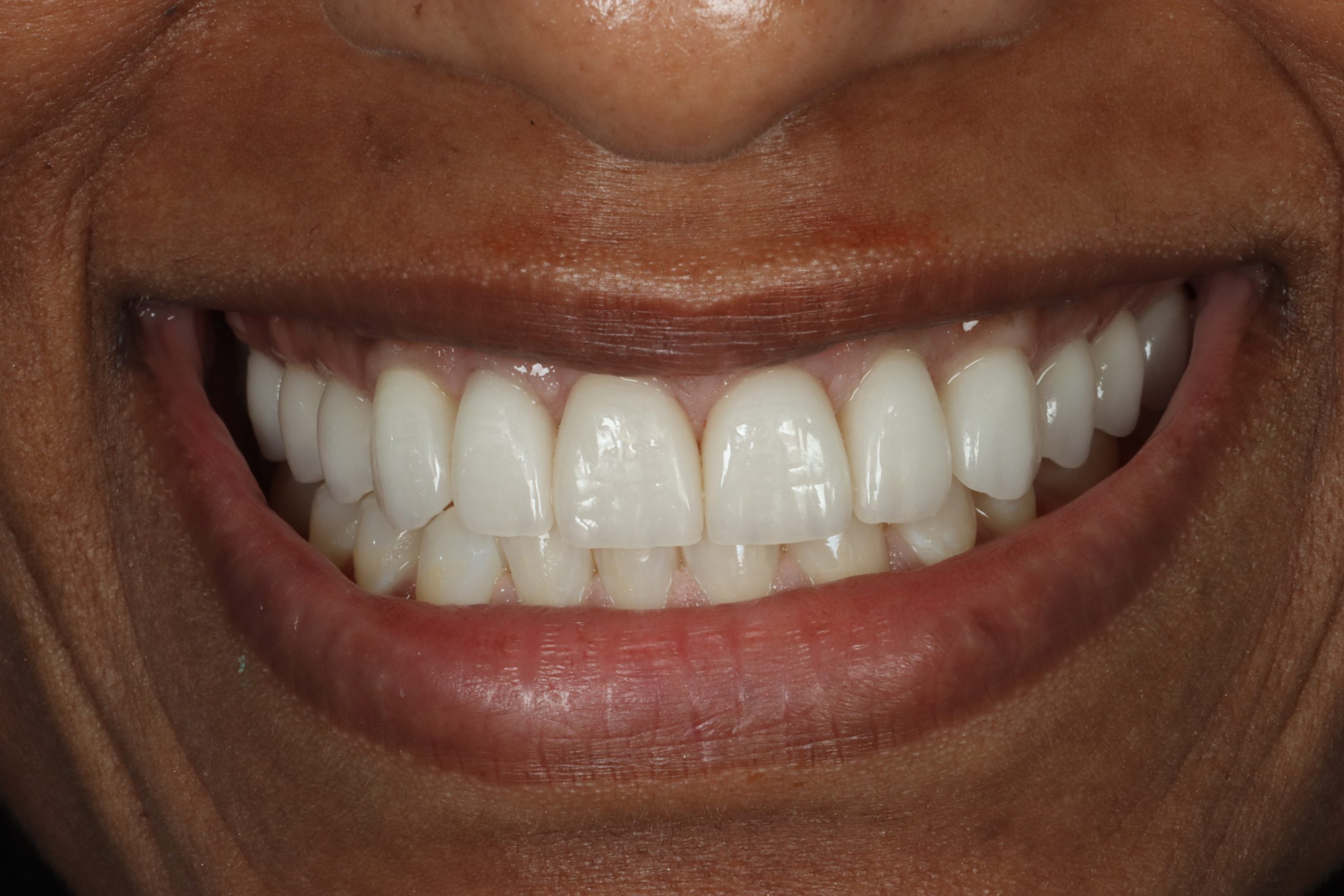 Tina S after dental veneers