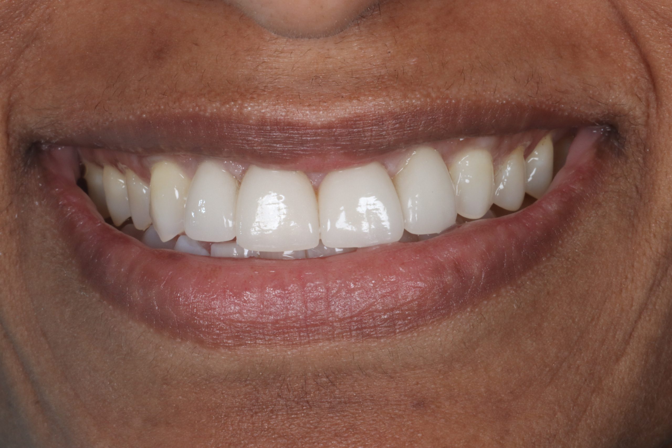 Tina S before dental veneers