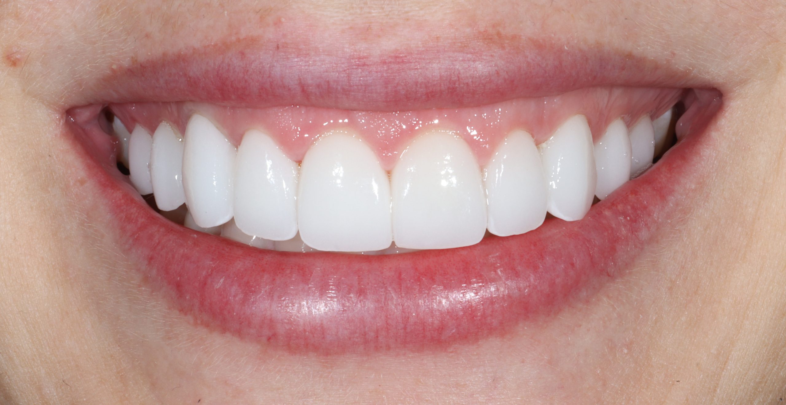 Valentina W after gummy smiles
