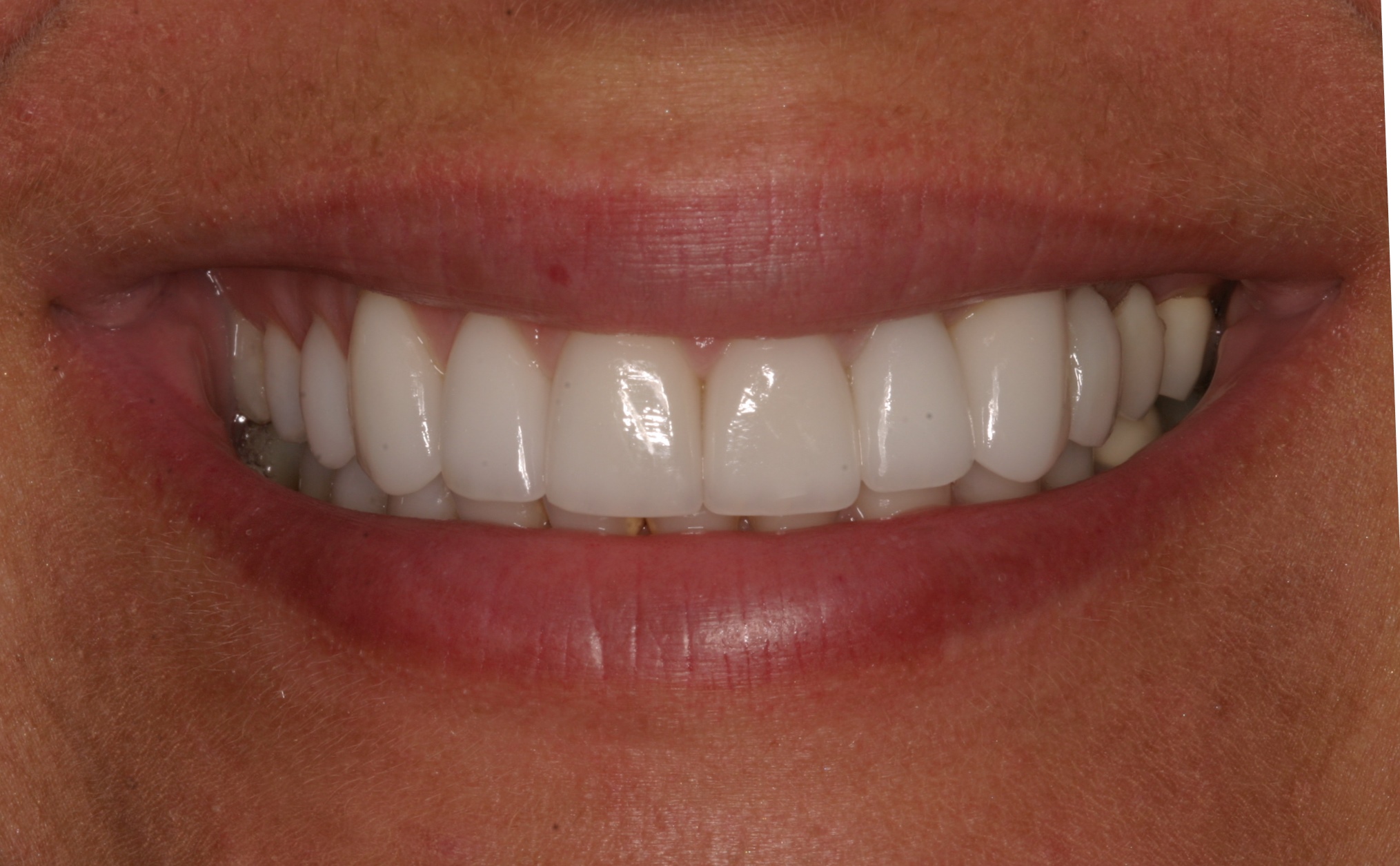 Vildana P after dental veneers