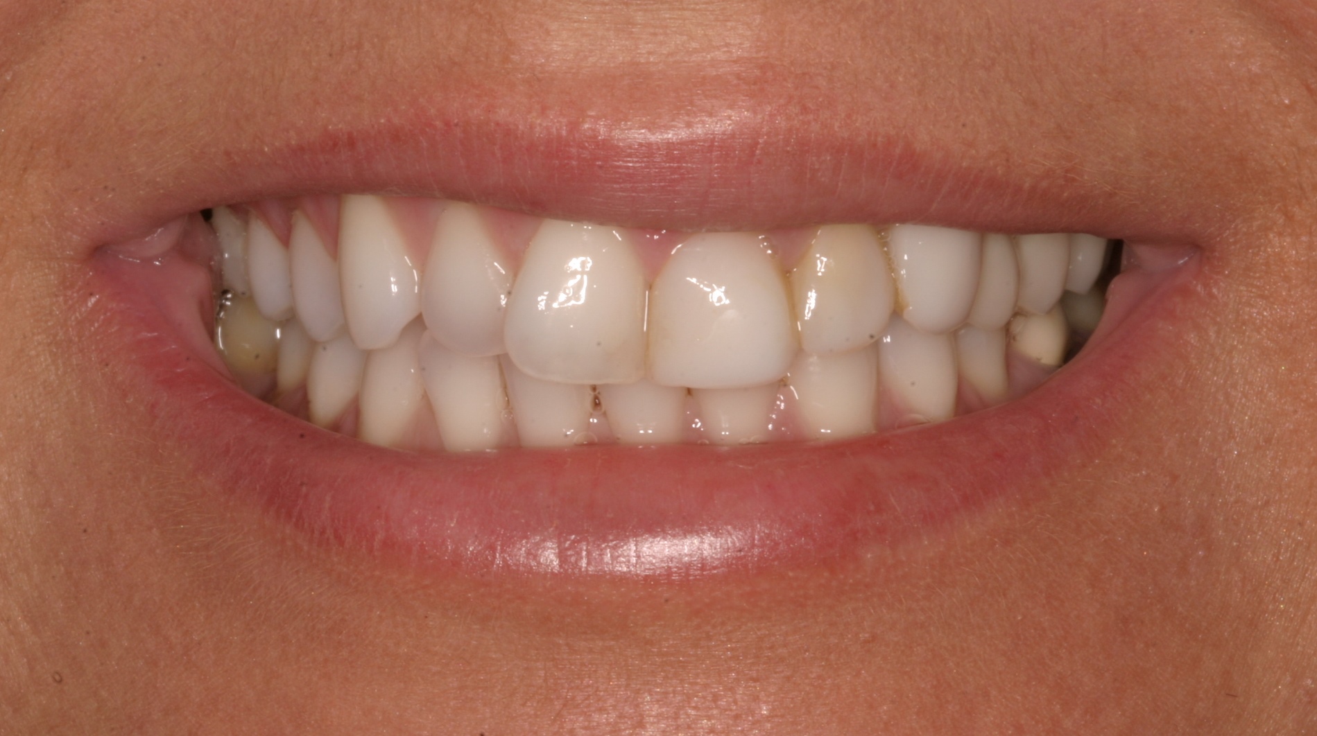 Vildana P before dental veneers