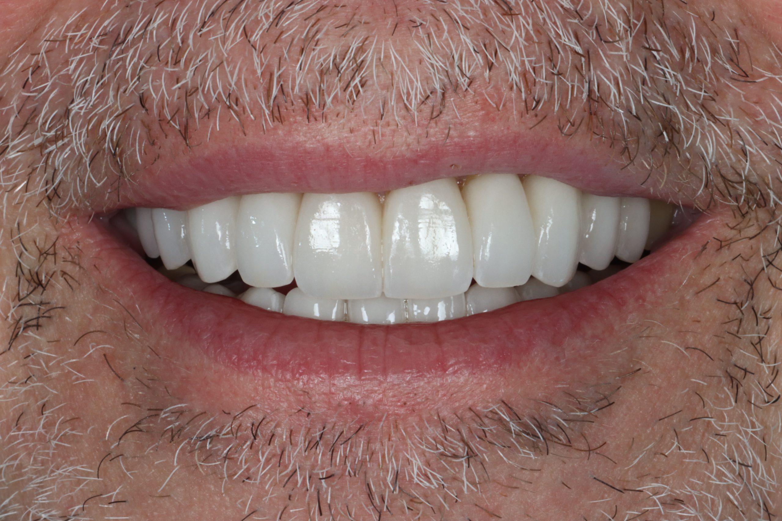 Vittorio G after smile rejuvenation