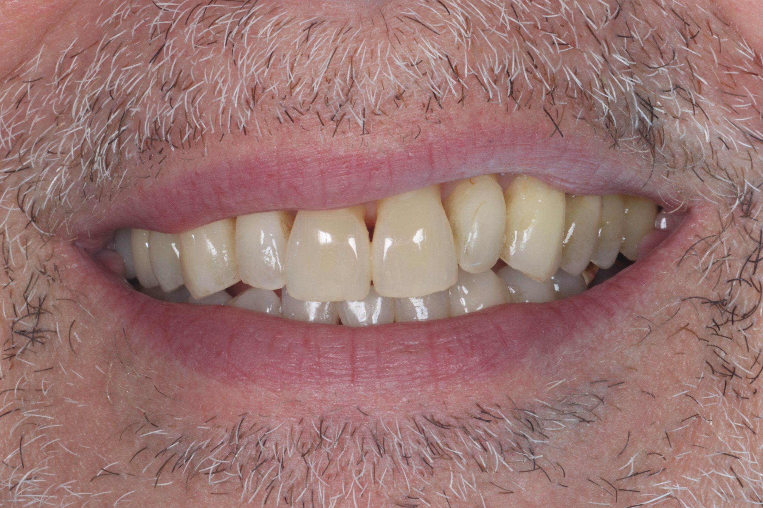 Vittorio G before smile rejuvenation