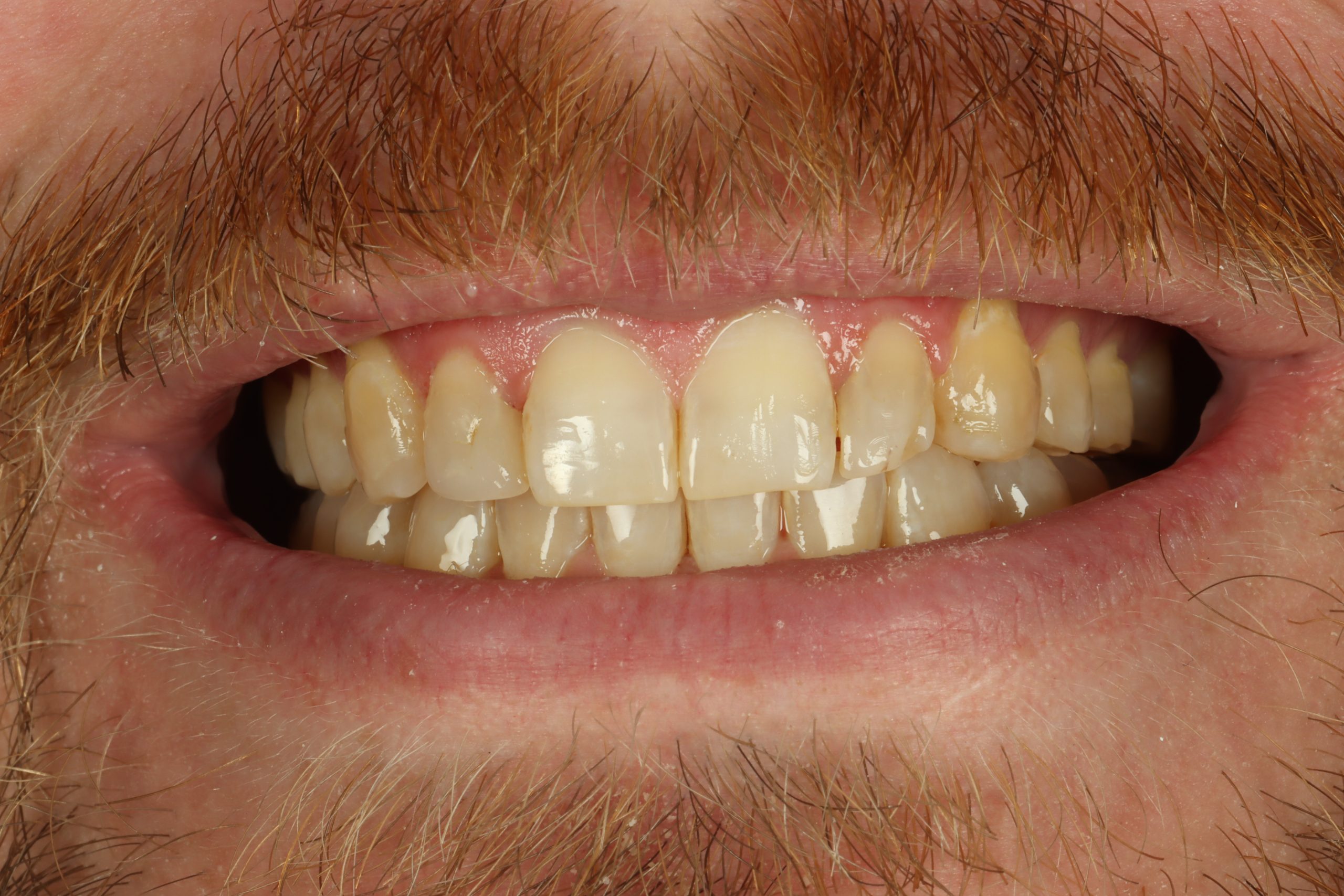 Zach A before dental veneers