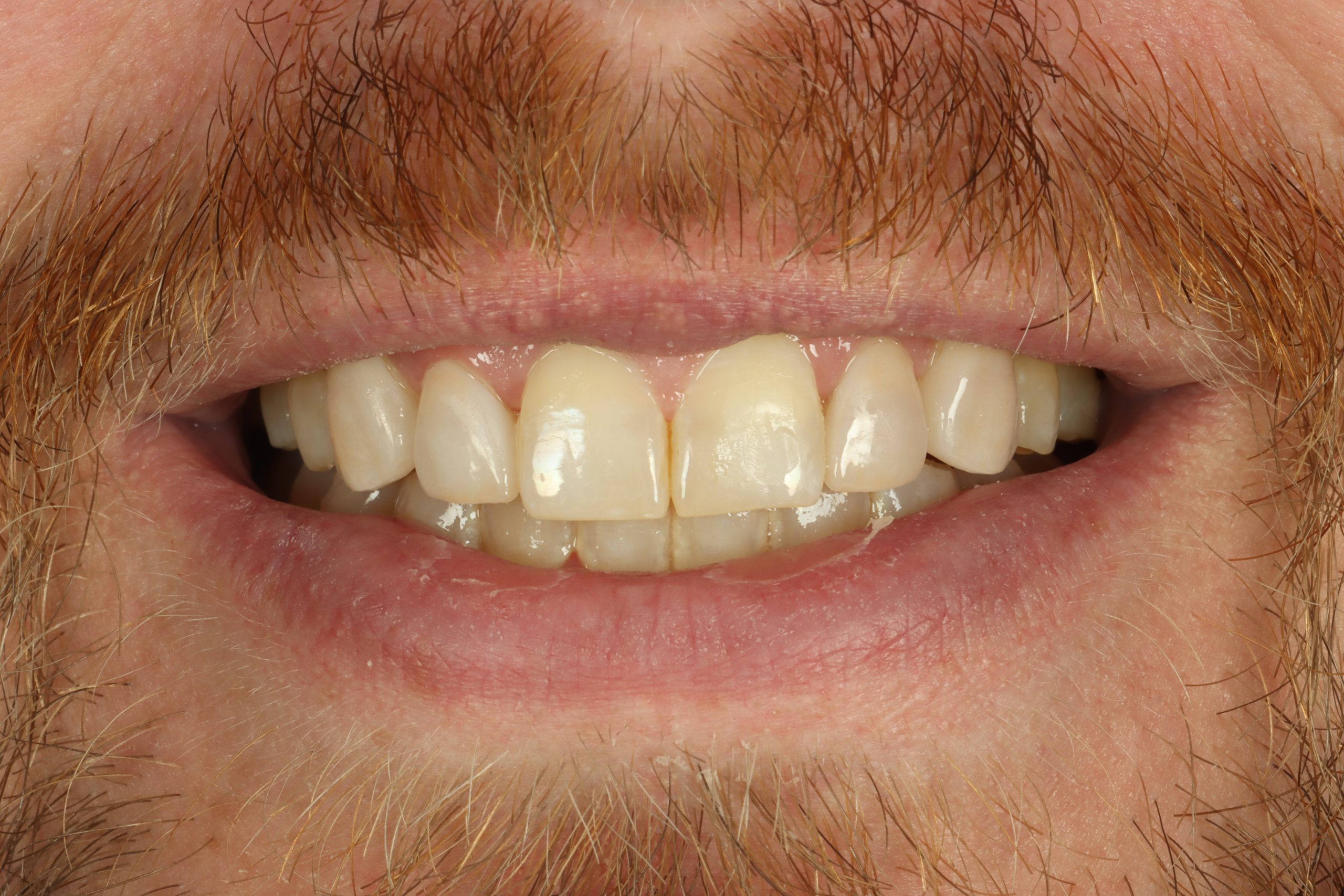 Zach A after dental veneers